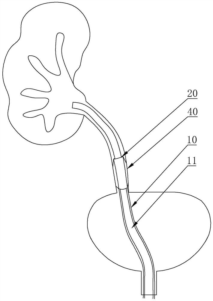 Device for monitoring pressure in renal pelvis