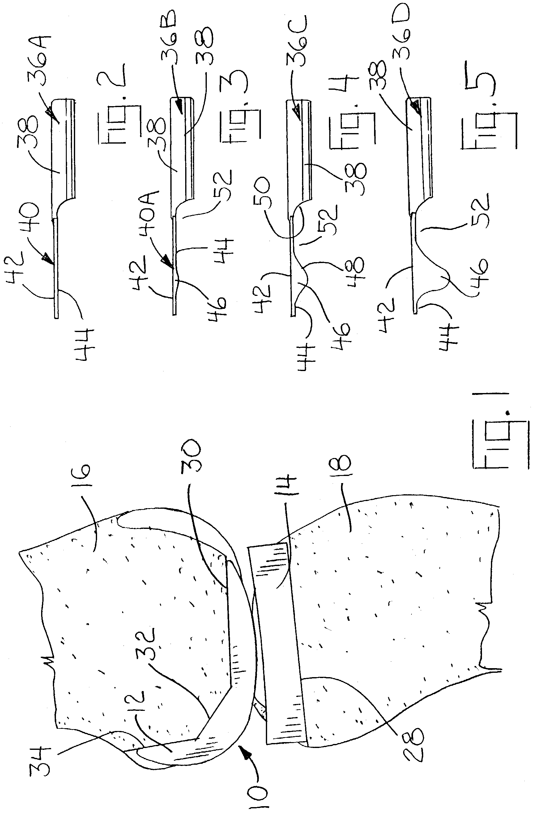 Method and apparatus for resecting a distal femur and a proximal tibia in preparation for implementing a partial knee prosthesis