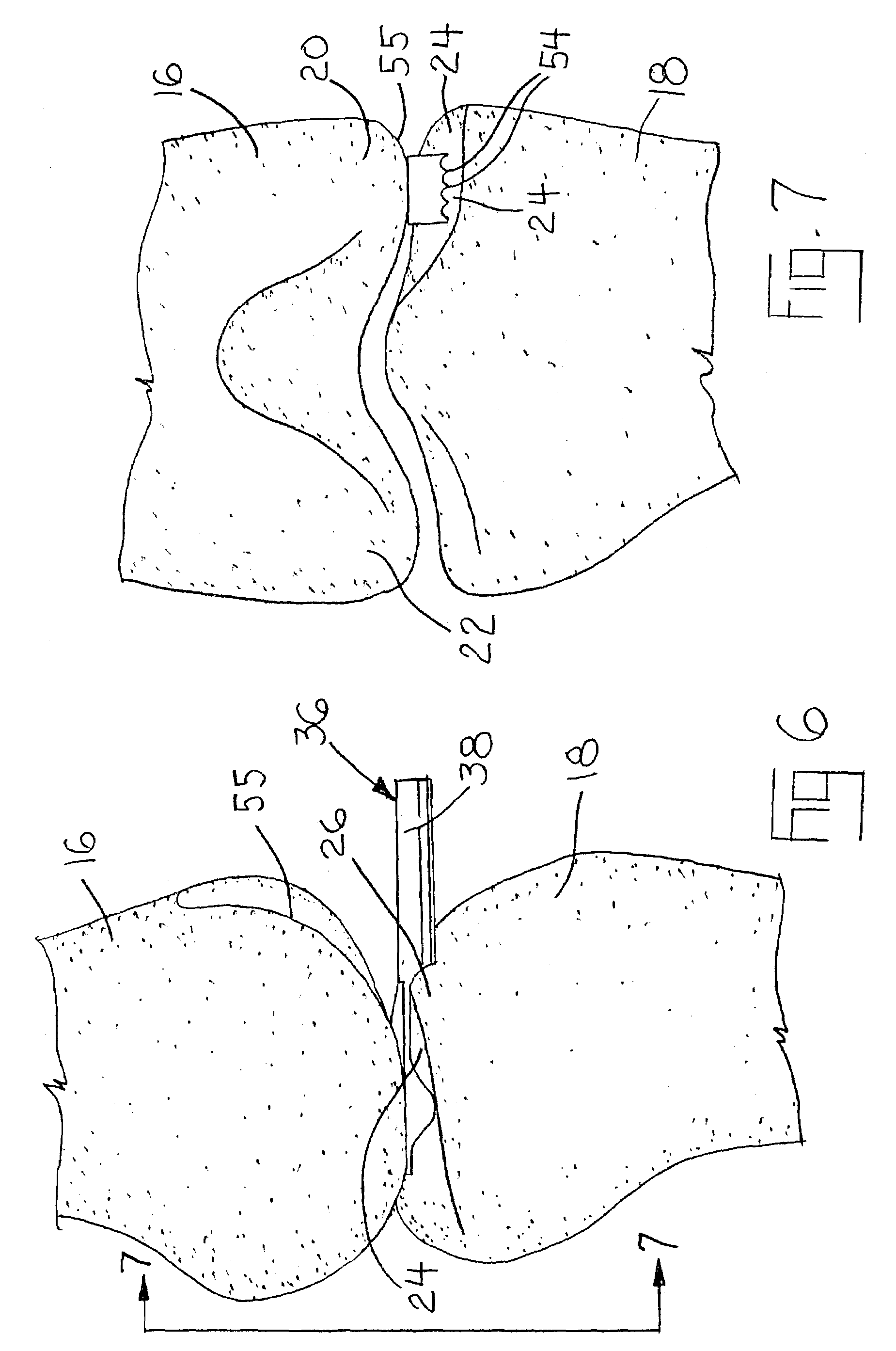 Method and apparatus for resecting a distal femur and a proximal tibia in preparation for implementing a partial knee prosthesis