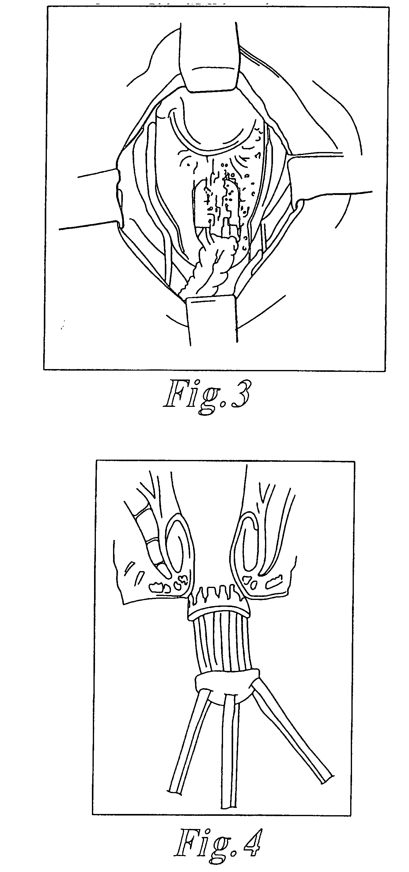 Methods and articles for treatment of rectal prolapse
