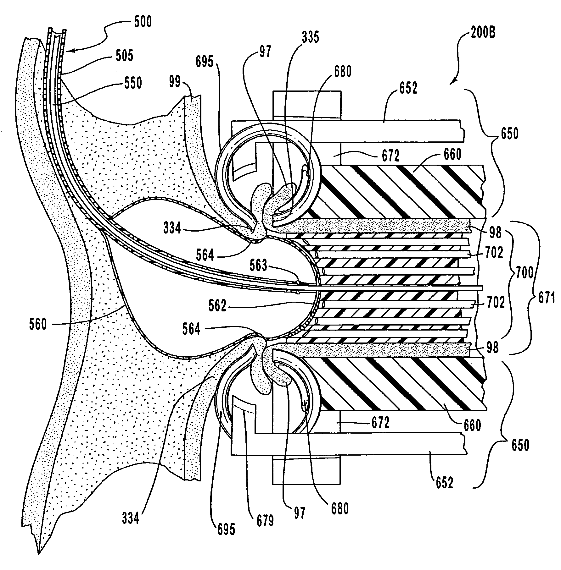 Methods for anastomosis of a graft vessel to a side of a receiving vessel