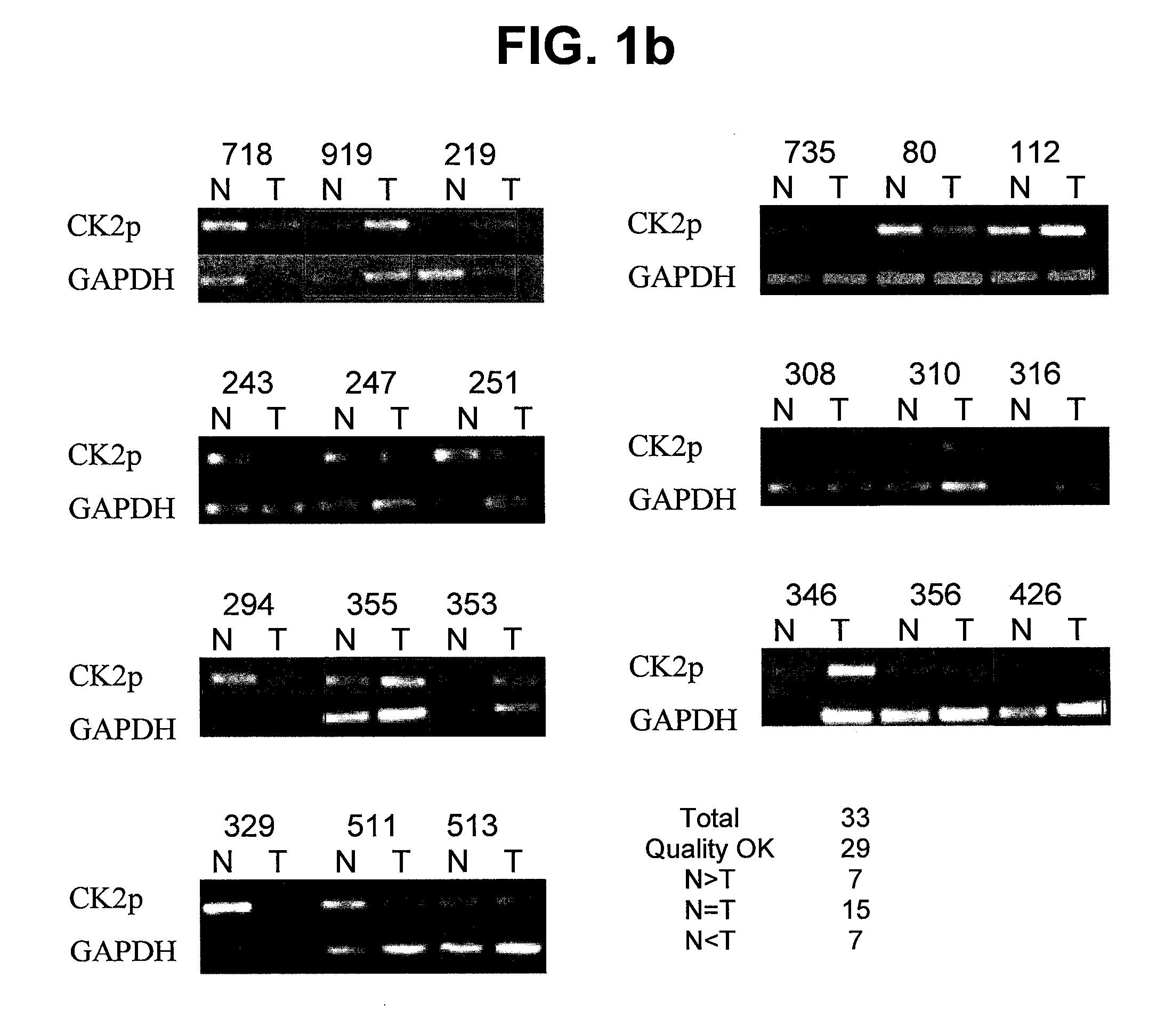 Protein kinase CK2 gene mutations, amplifications and polymorphisms in human cancers and methods of use