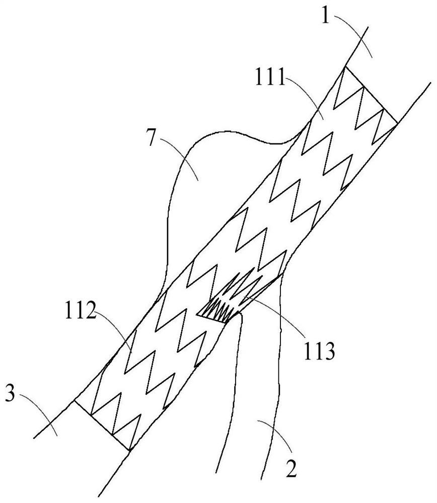 Branched Vascular Stent