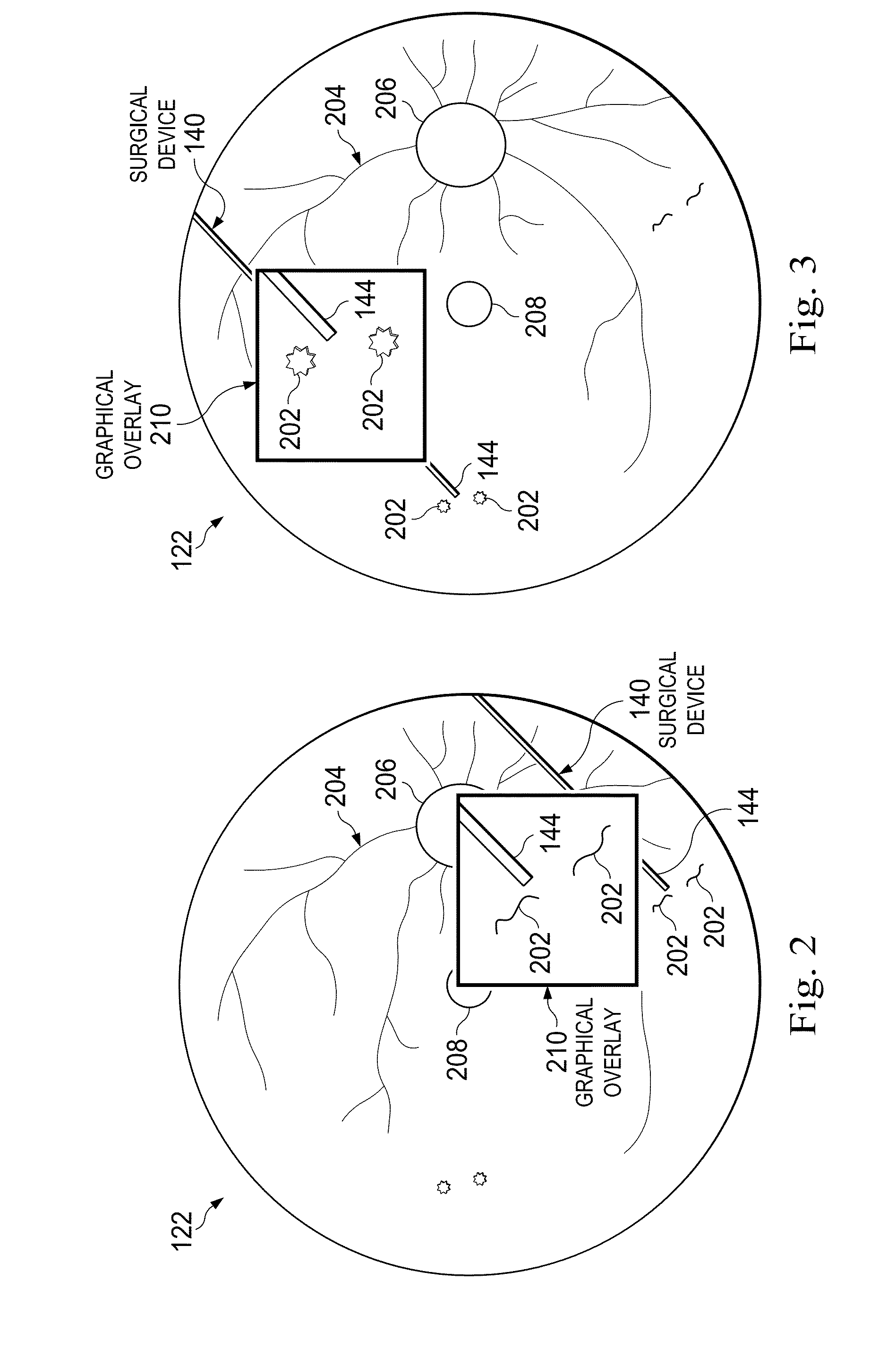 Magnification in Ophthalmic Procedures and Associated Devices, Systems, and Methods