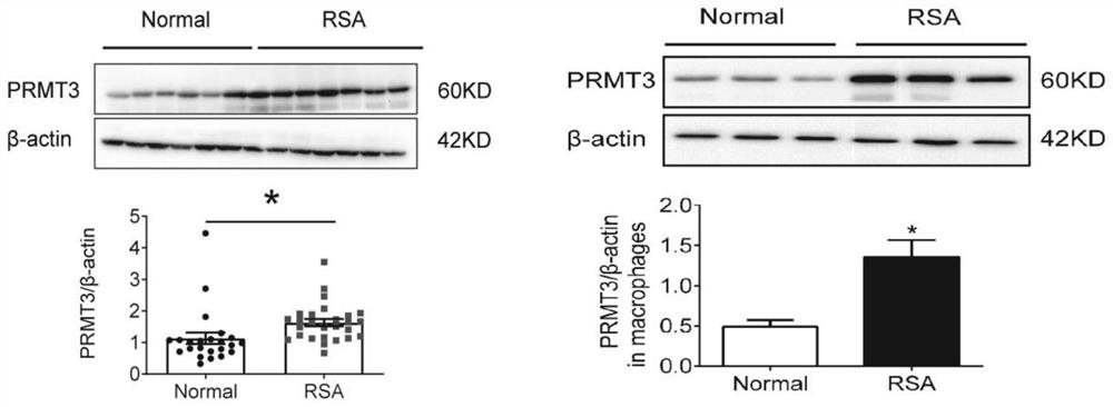 Application of PRMT3 in diagnosis or treatment of recurrent spontaneous abortion