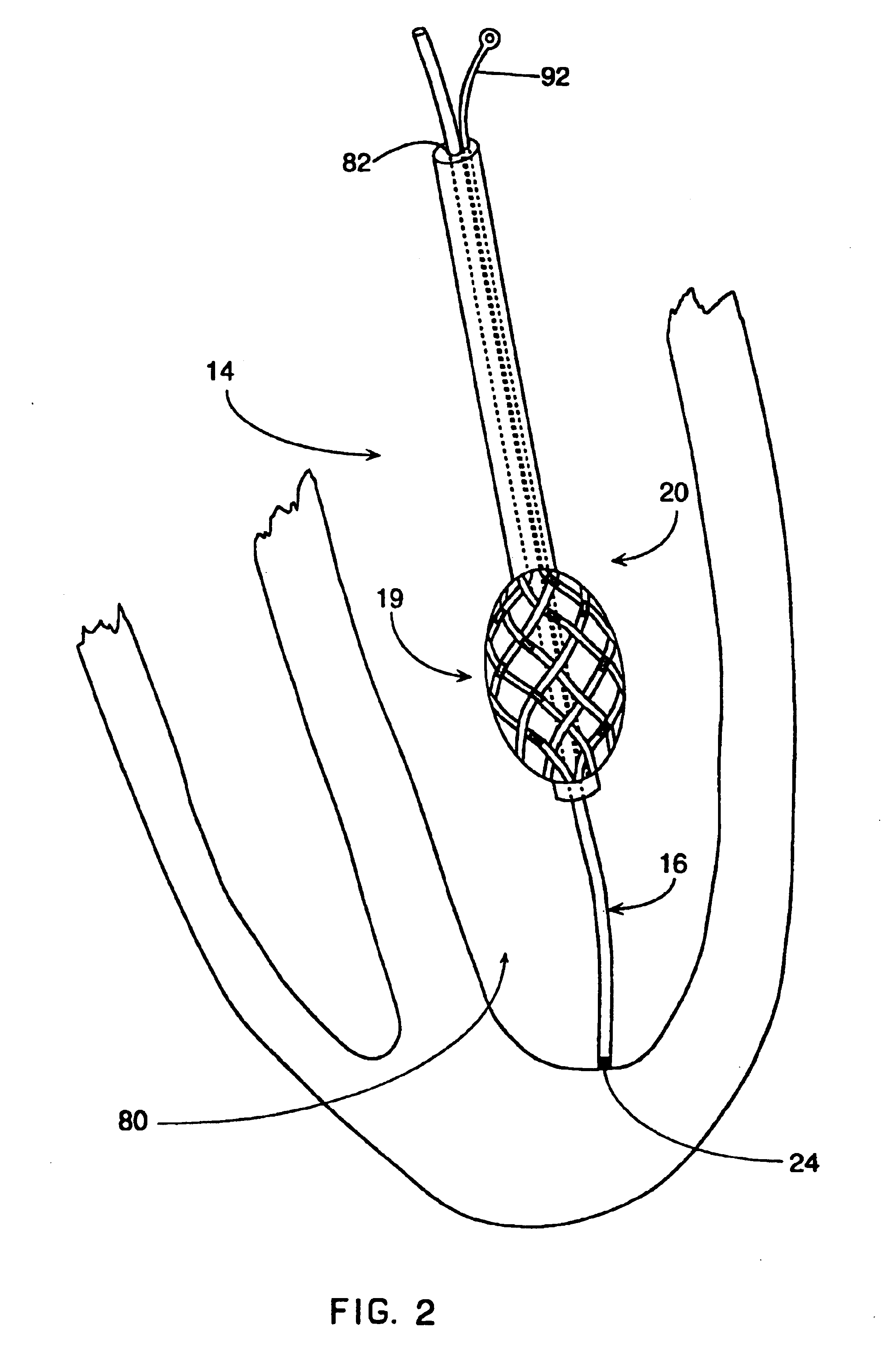 Method of mapping a plug in a mapping catheter