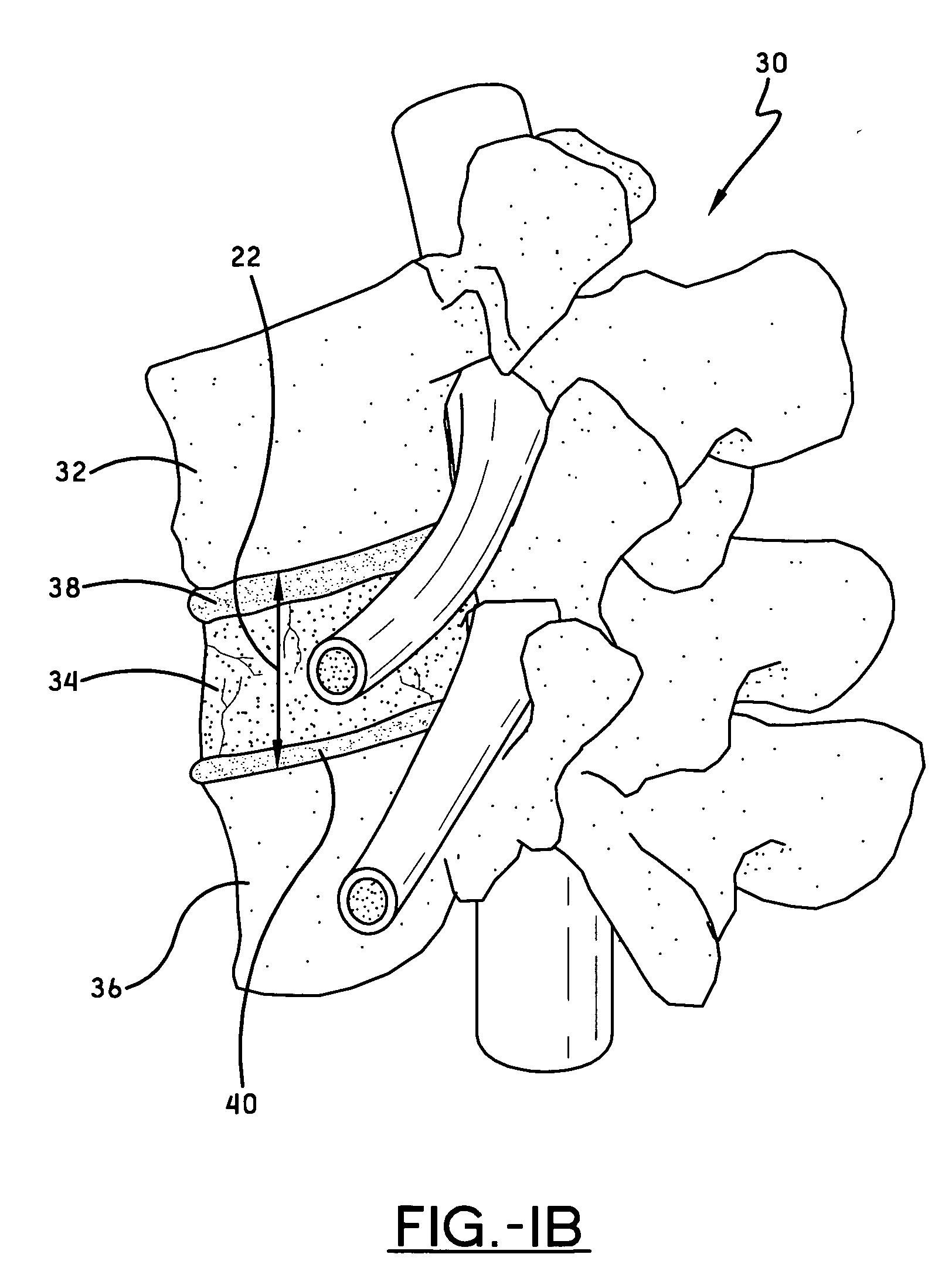 Spine surgery method and motion preserving implant