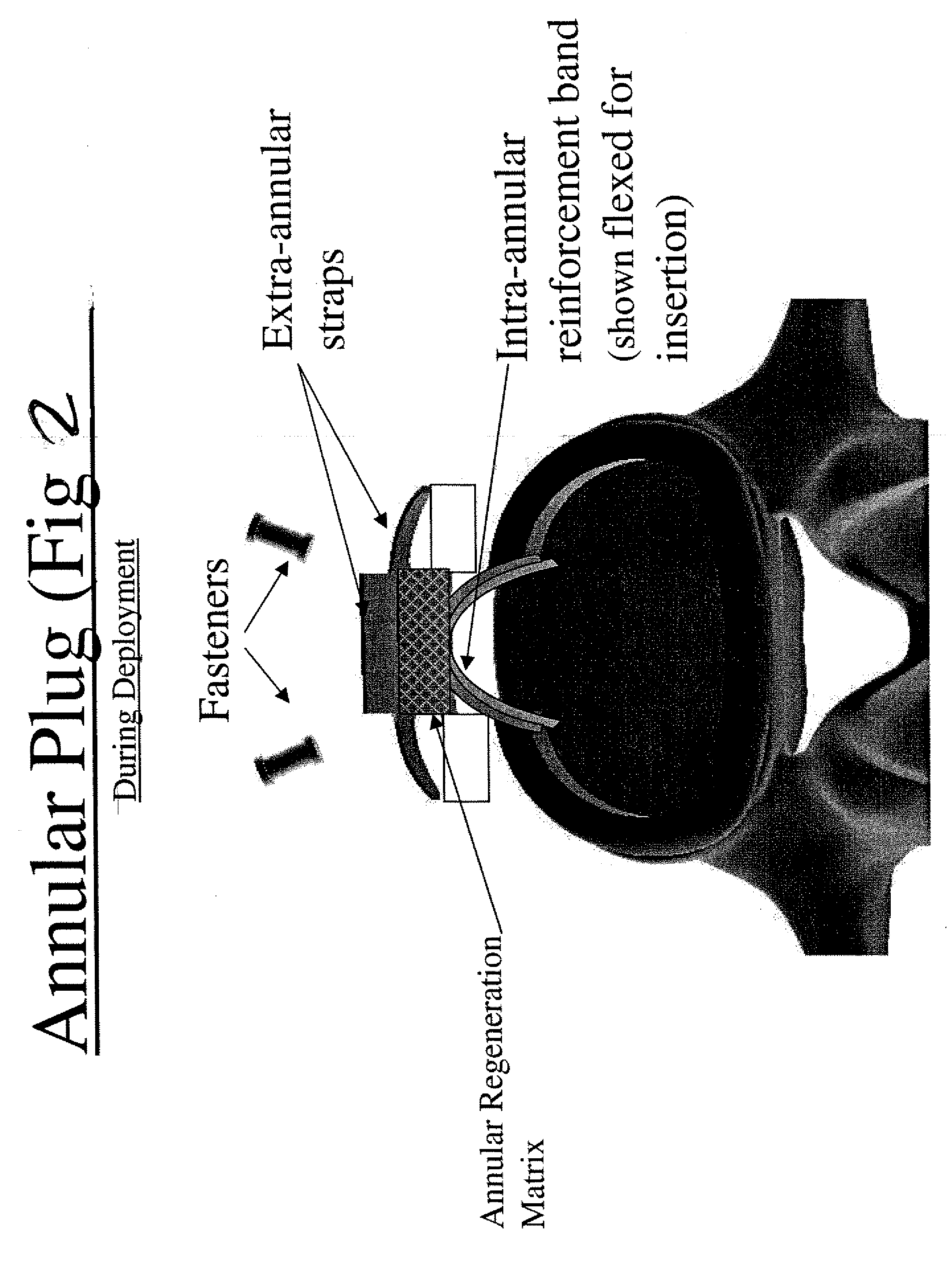 Annulus fibrosus repair devices and techniques