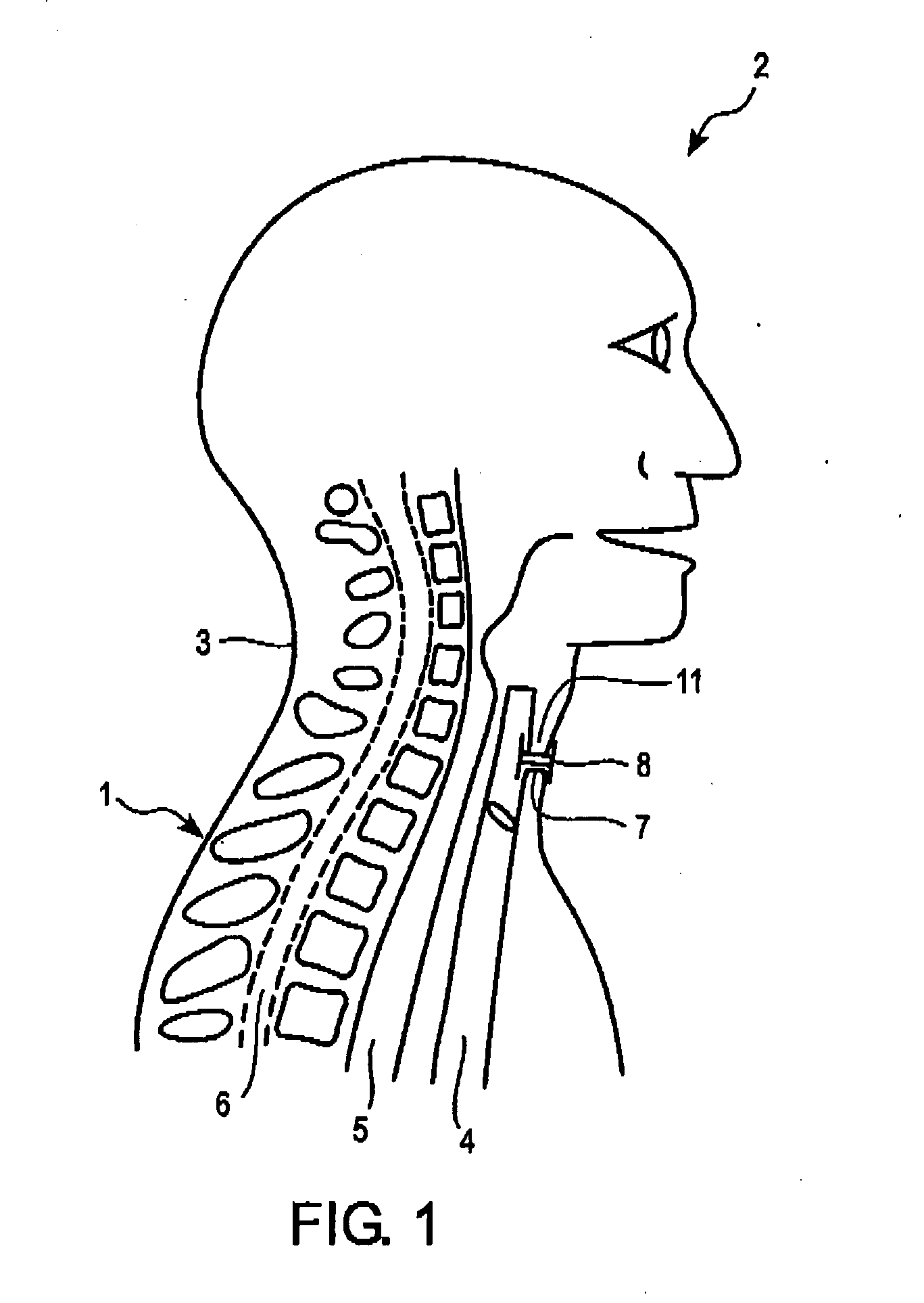 Tracheostoma spacer, tracheotomy method, and device for inserting a tracheostoma spacer
