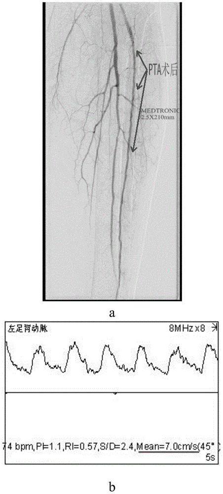 Use of CD133&lt;+&gt; endothelial precursor cells