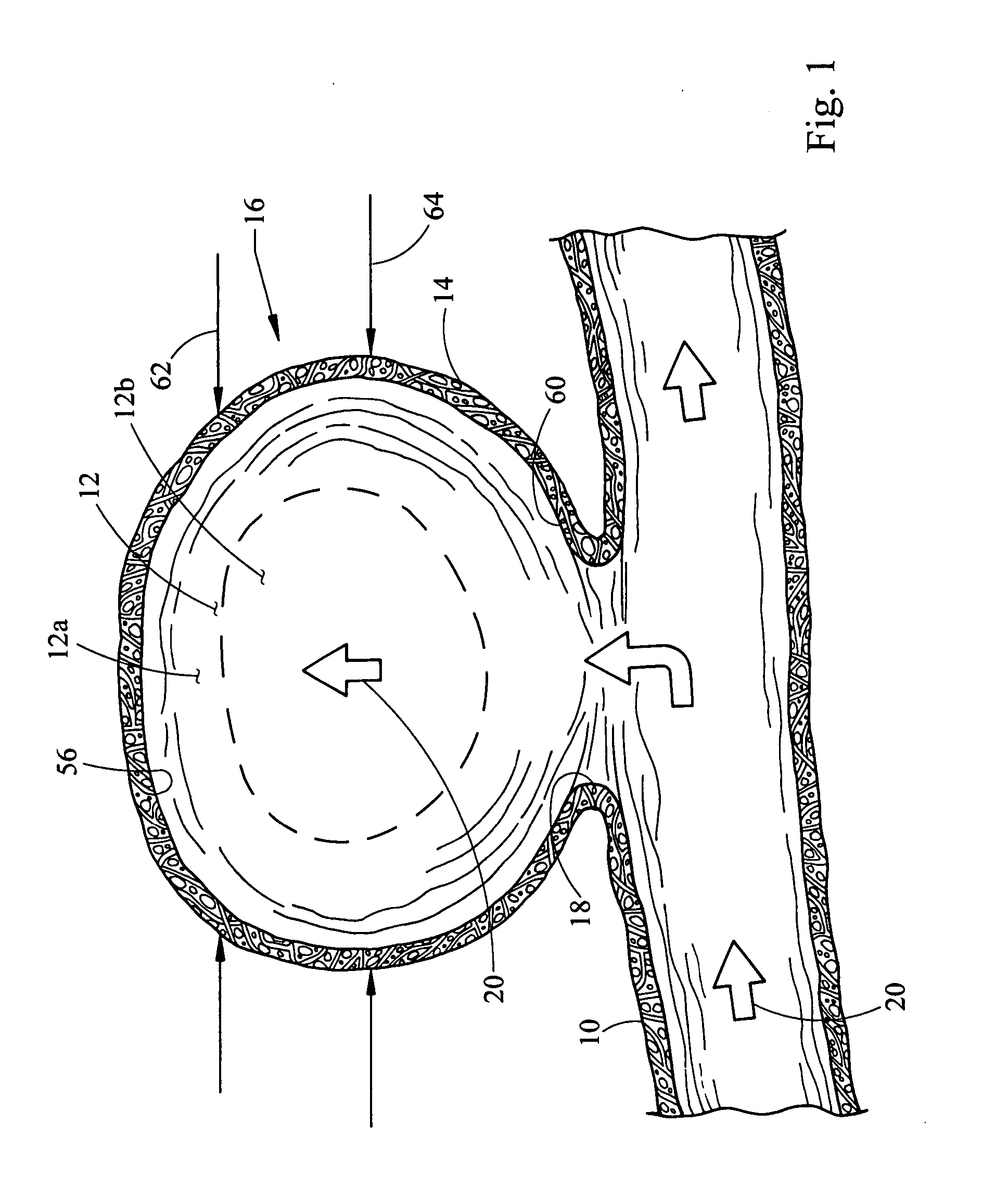 Aneurysm coil and method of assembly