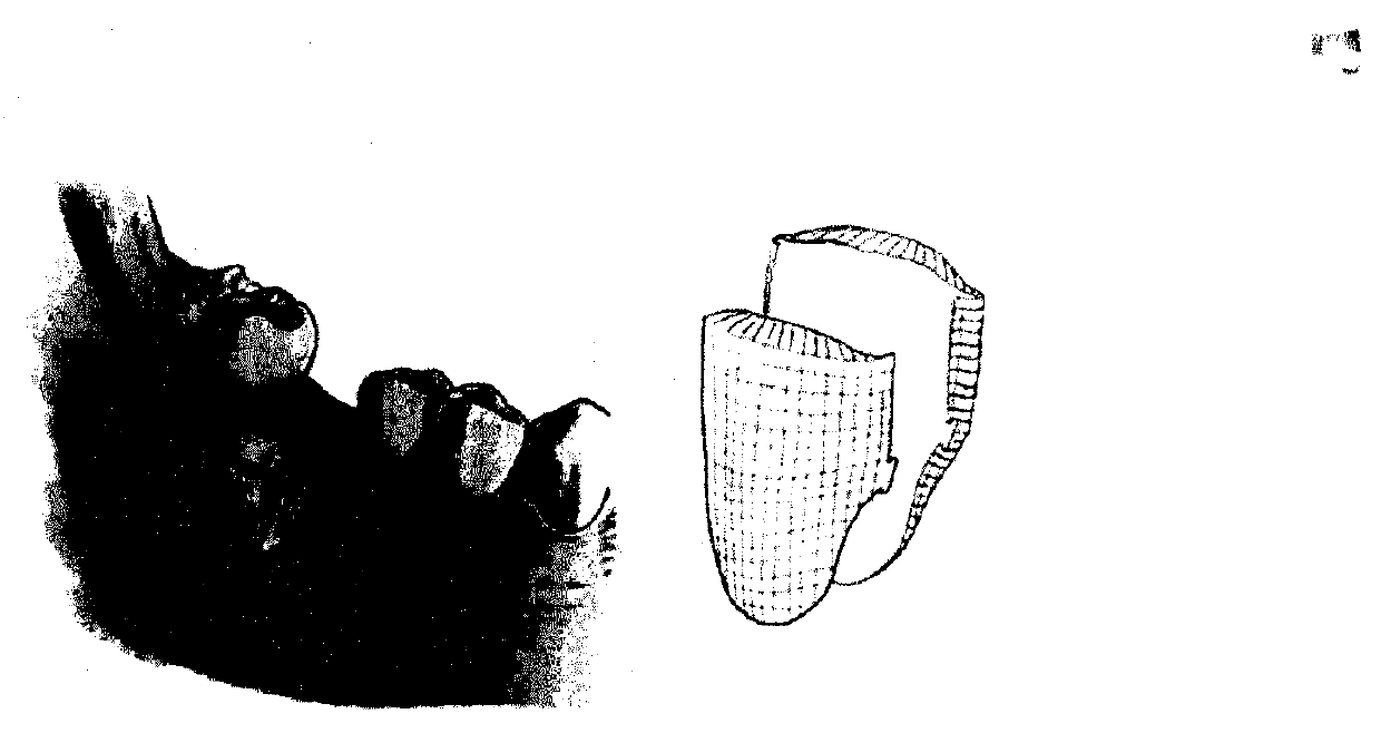 A 3D printed personalized cage dental bone graft guide