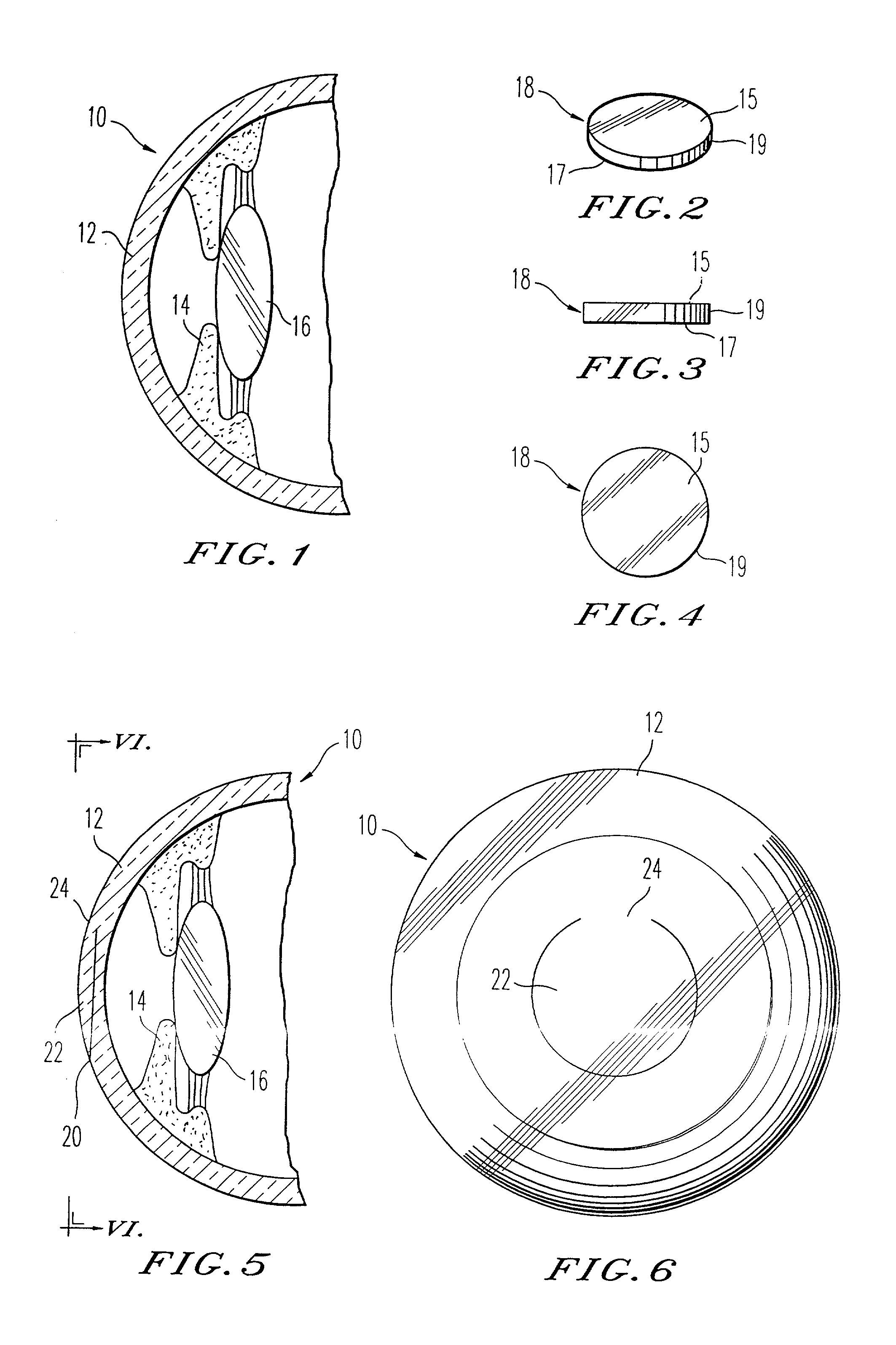 Adjustable universal implant blank for modifying corneal curvature and methods of modifying corneal curvature therewith