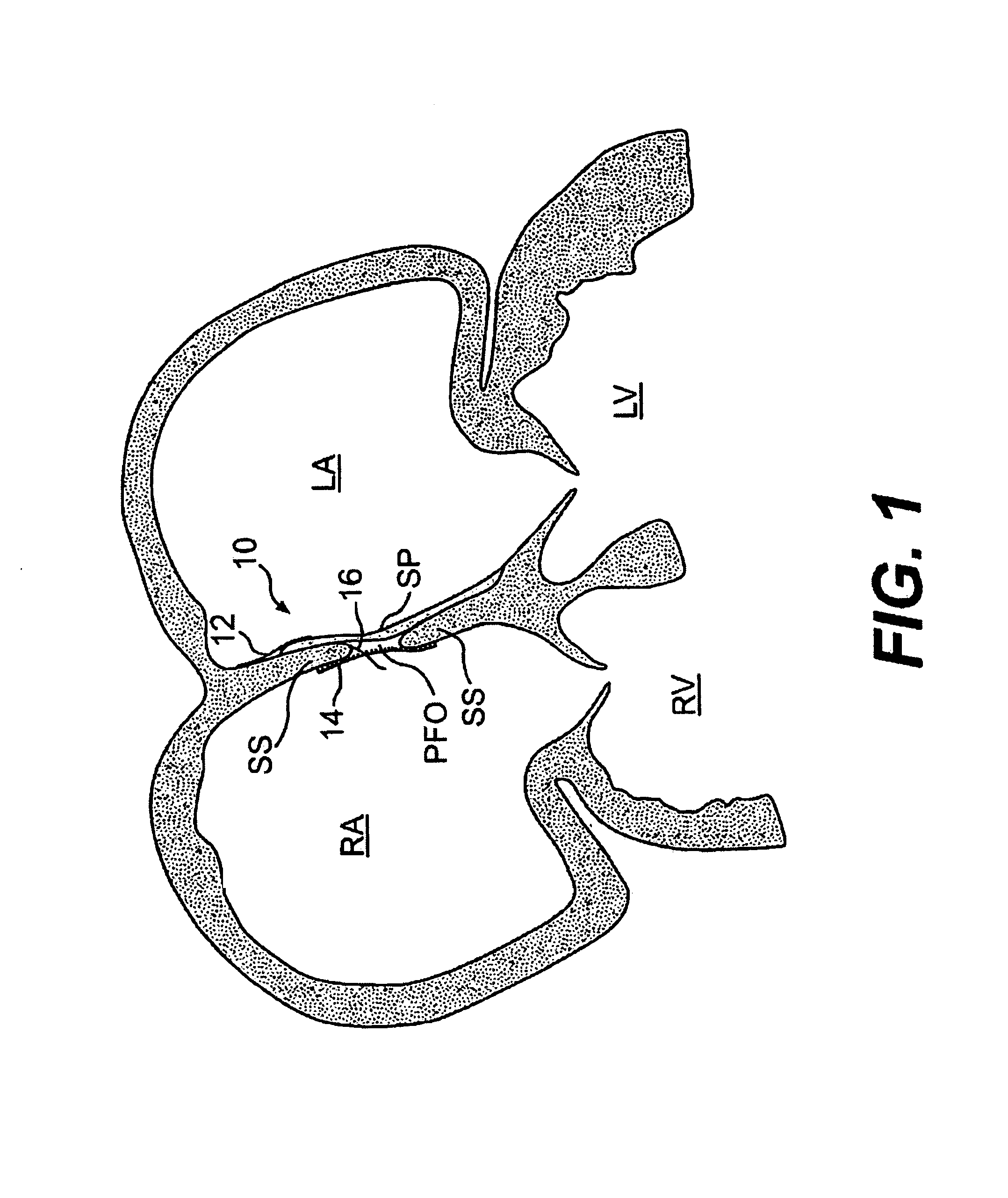 Closure devices, related delivery methods and tools, and related methods of use