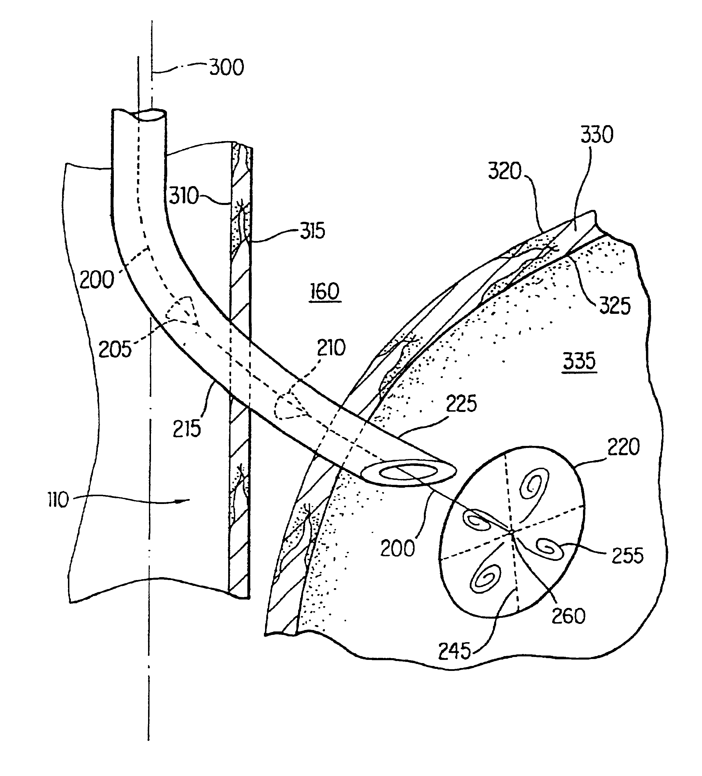 Method and apparatus for endoscopic repair of the lower esophageal sphincter