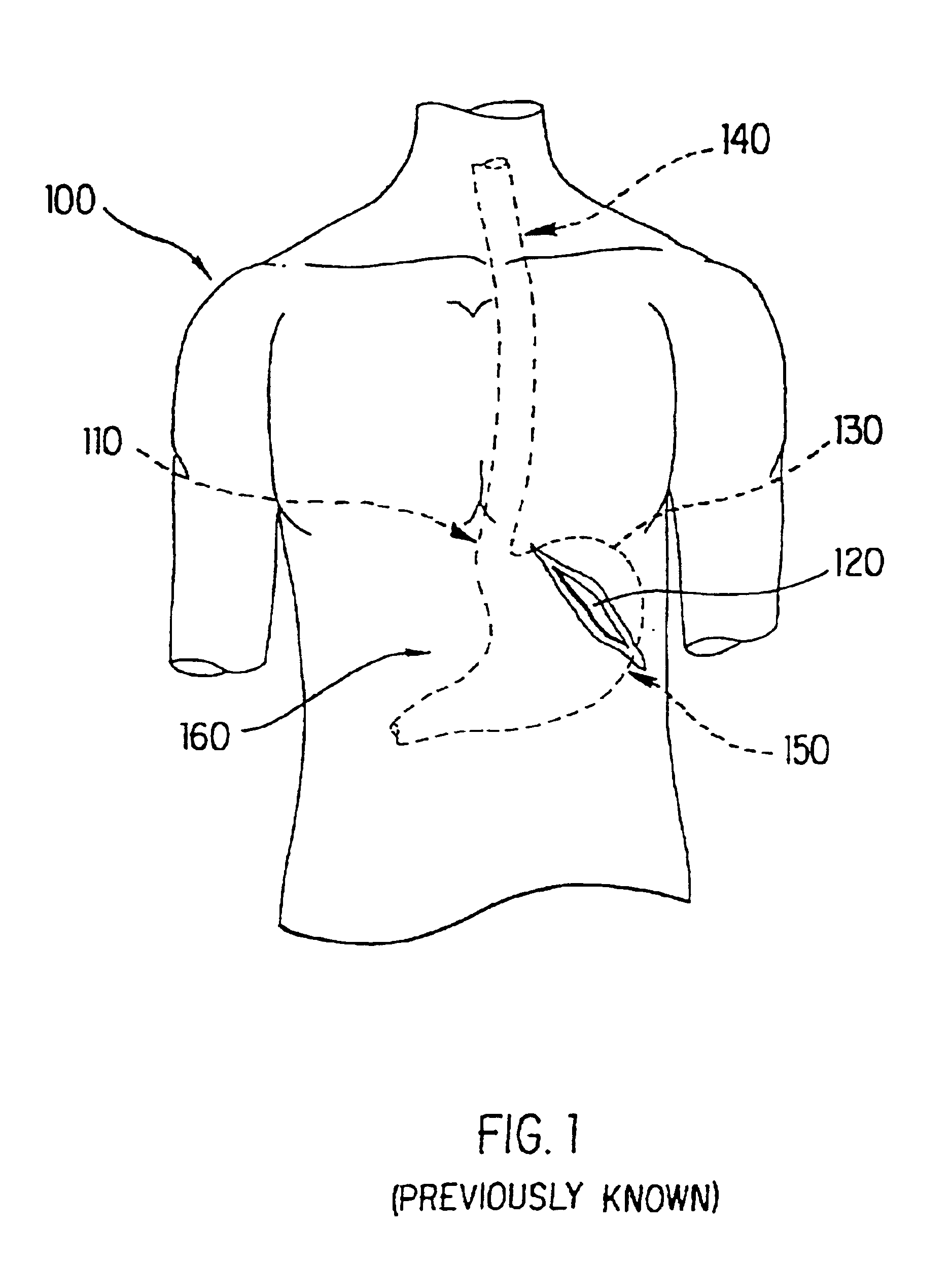 Method and apparatus for endoscopic repair of the lower esophageal sphincter