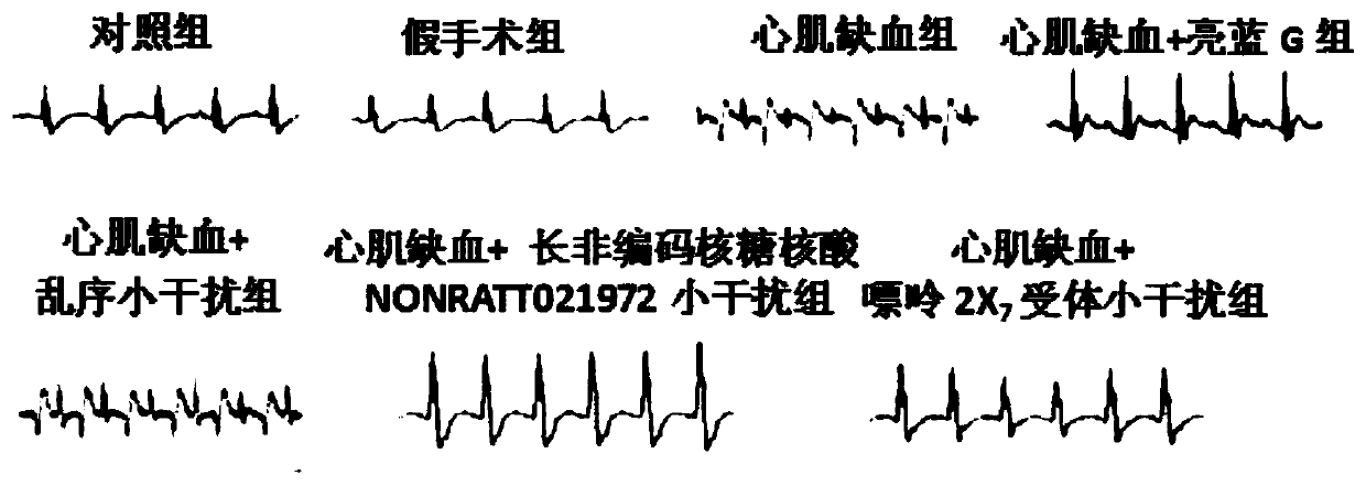 Application of nonratt021972 small interfering RNA in the preparation of drugs for myocardial ischemia injury and sympathetic nerve disease