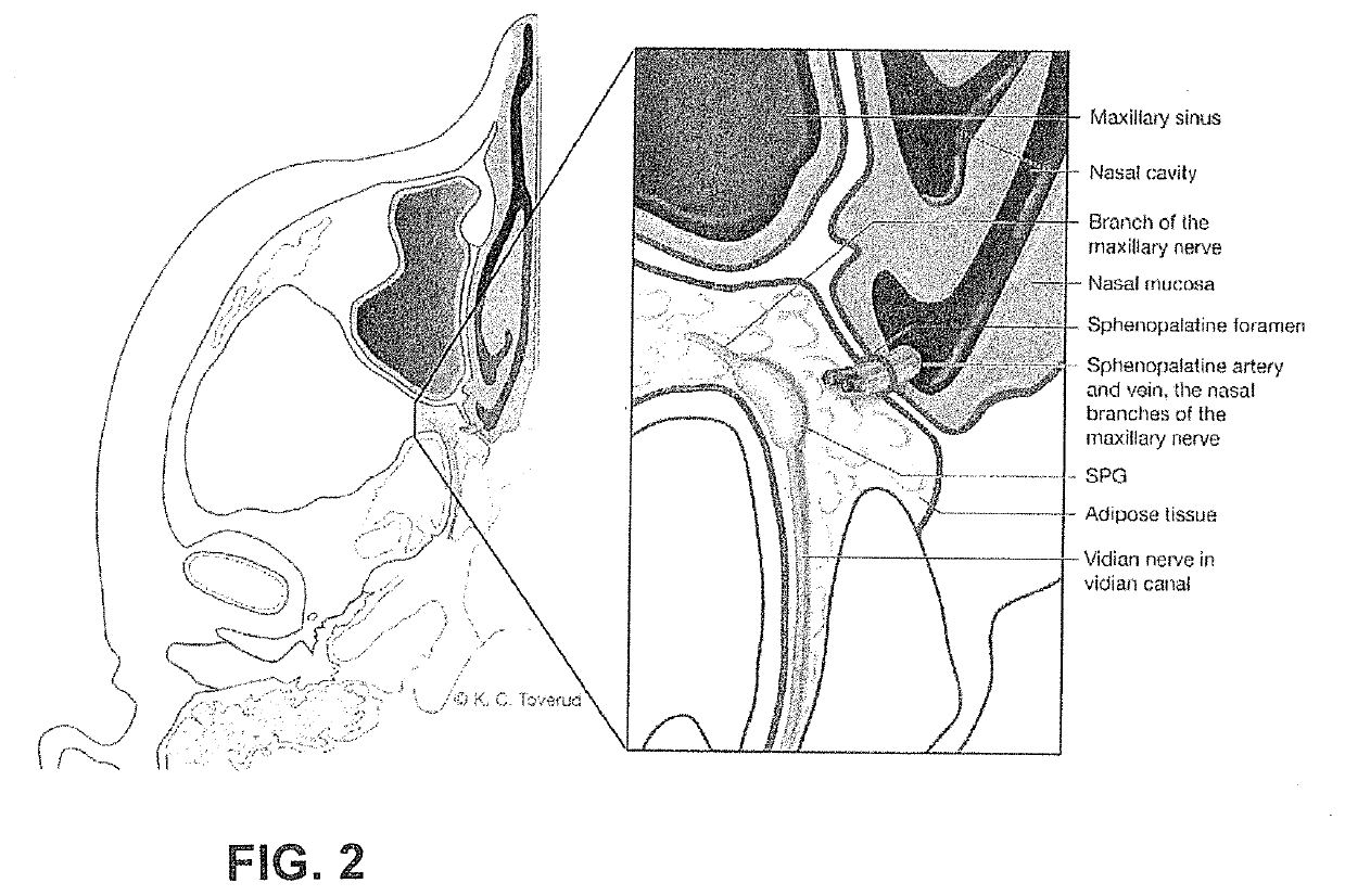 Method for Treating Head or Cranium Pain Including Migraine and Cluster Headaches