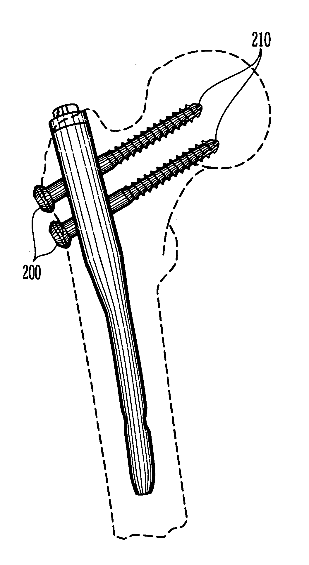 Intramedullary rod with spiraling flutes