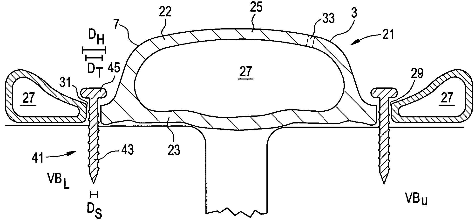 In-situ formed posterolateral fusion system