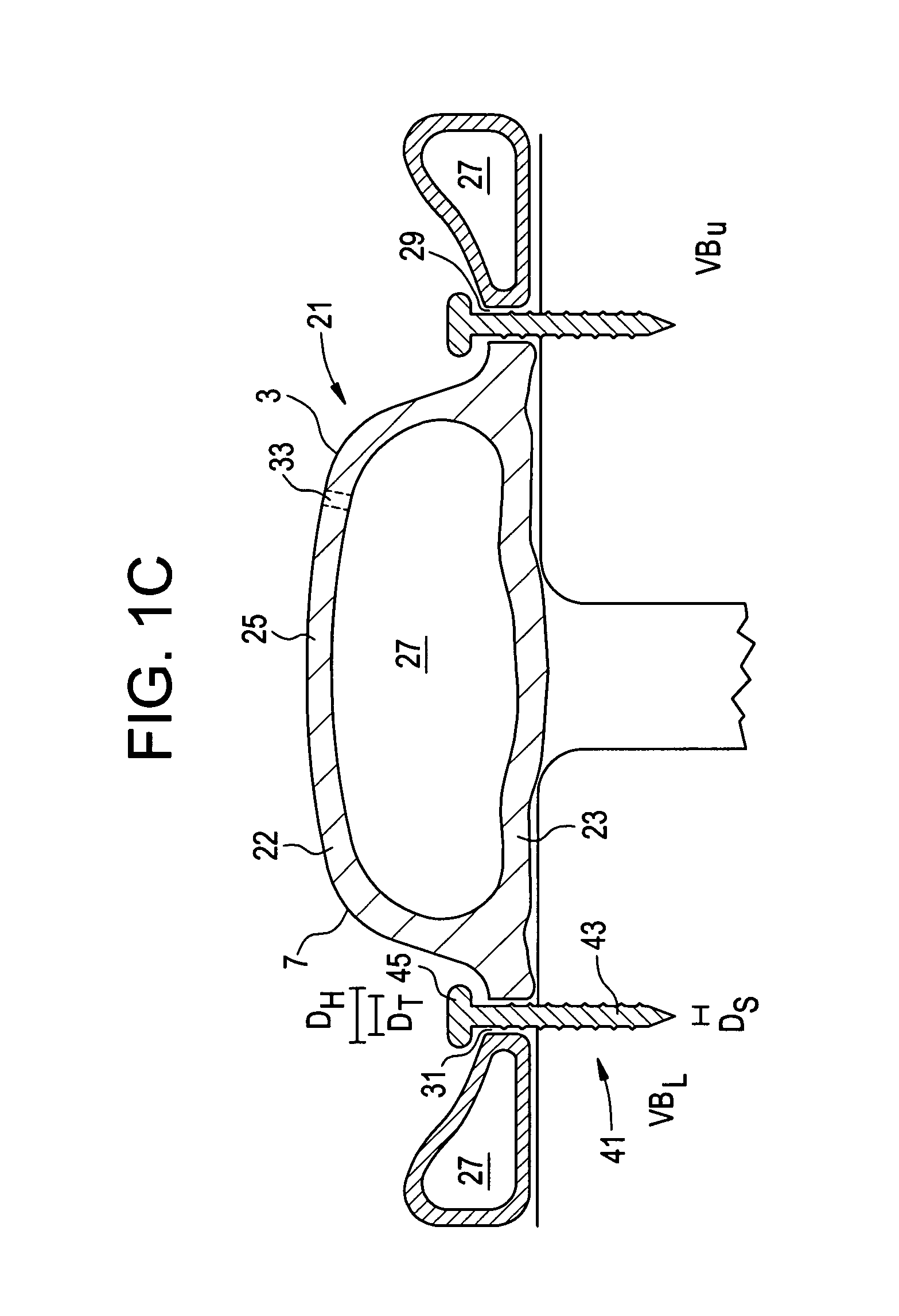 In-situ formed posterolateral fusion system