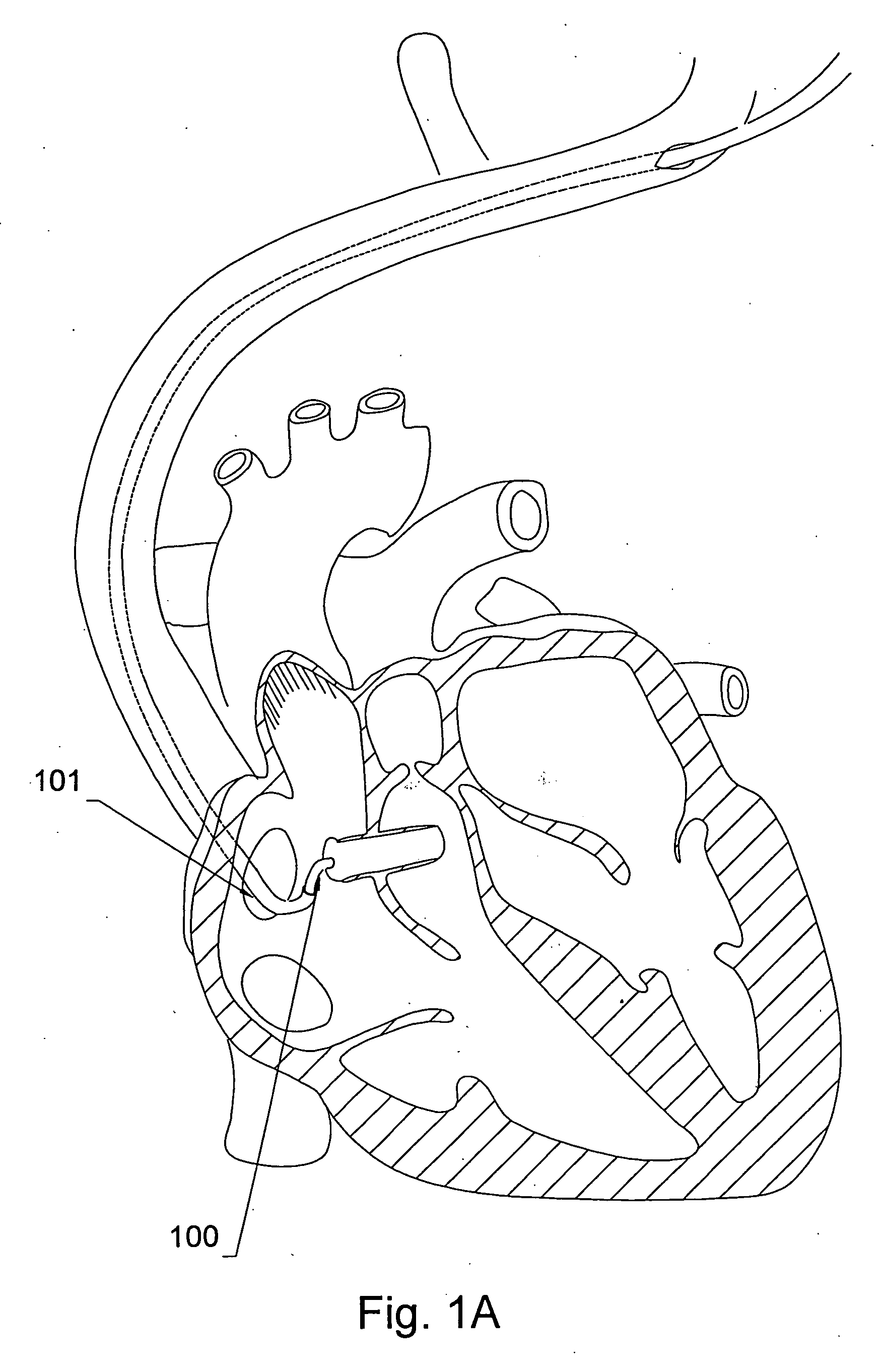 Methods of using a telescoping guide catheter with peel-away outer sheath