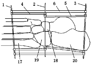A high-stretch reducer for calcaneal fracture
