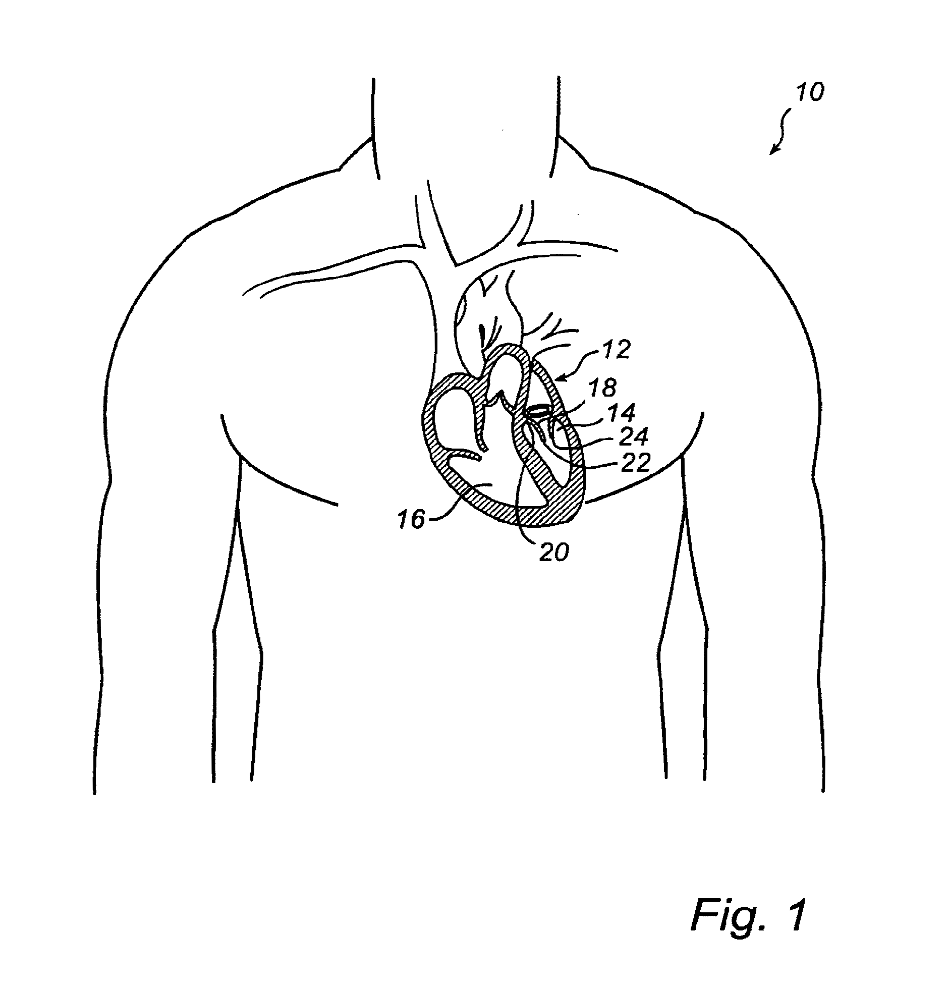 System For Improving The Function Of A Heart Valve