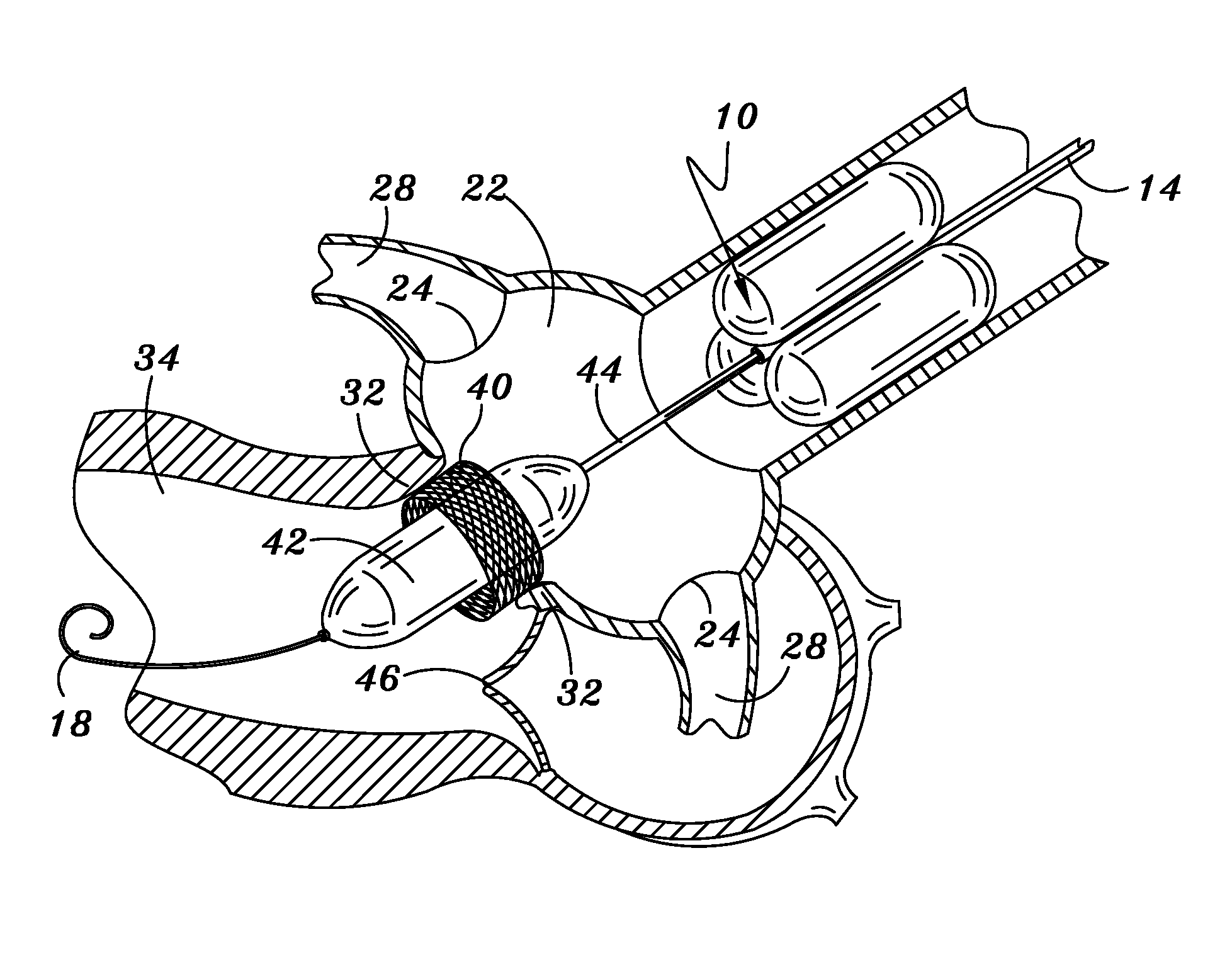 Methods and apparatus for percutaneous aortic valve replacement