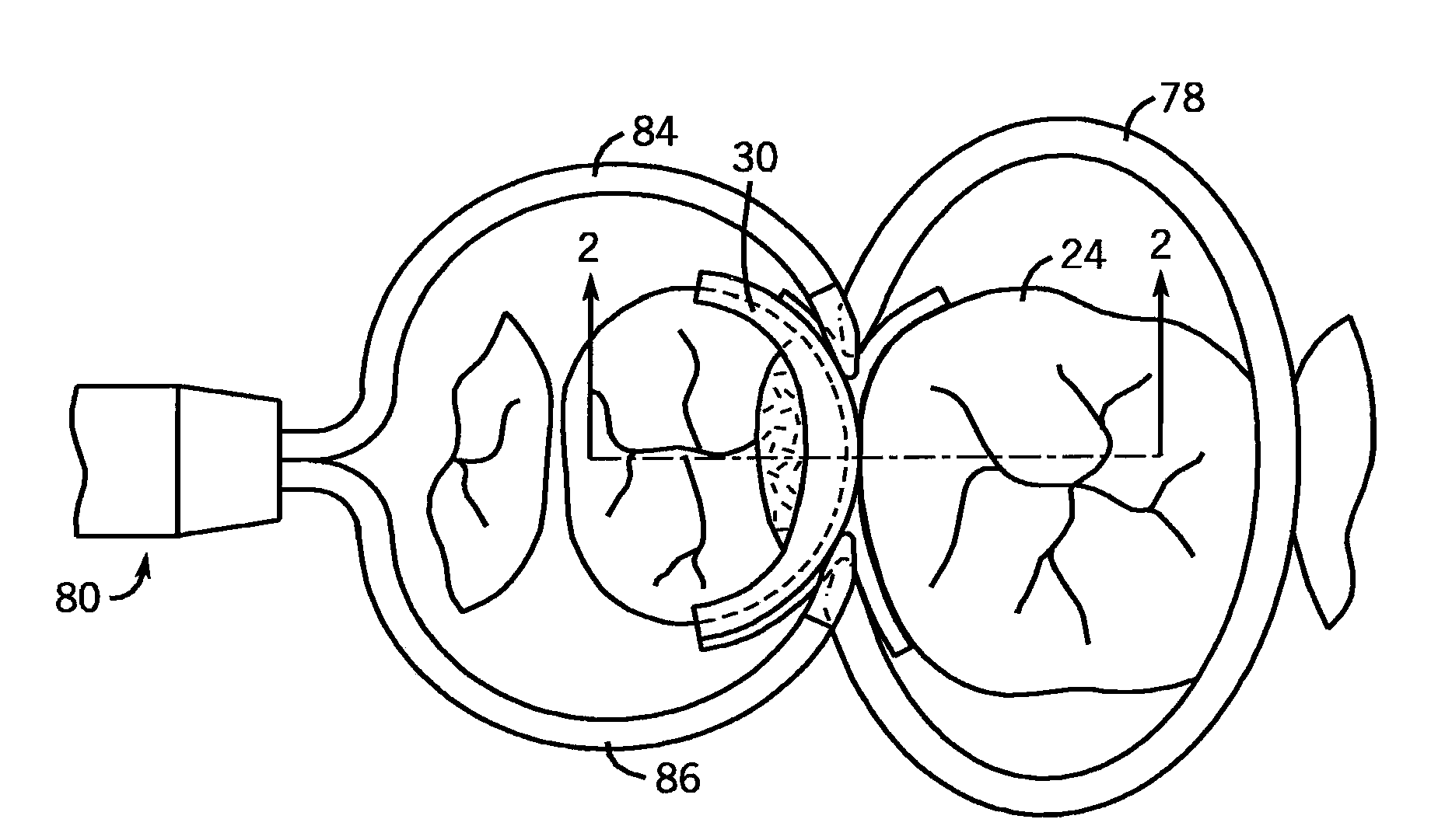 Dental Separator Rings And A Seamless, Single Load Cavity Preparation And Filling Technique