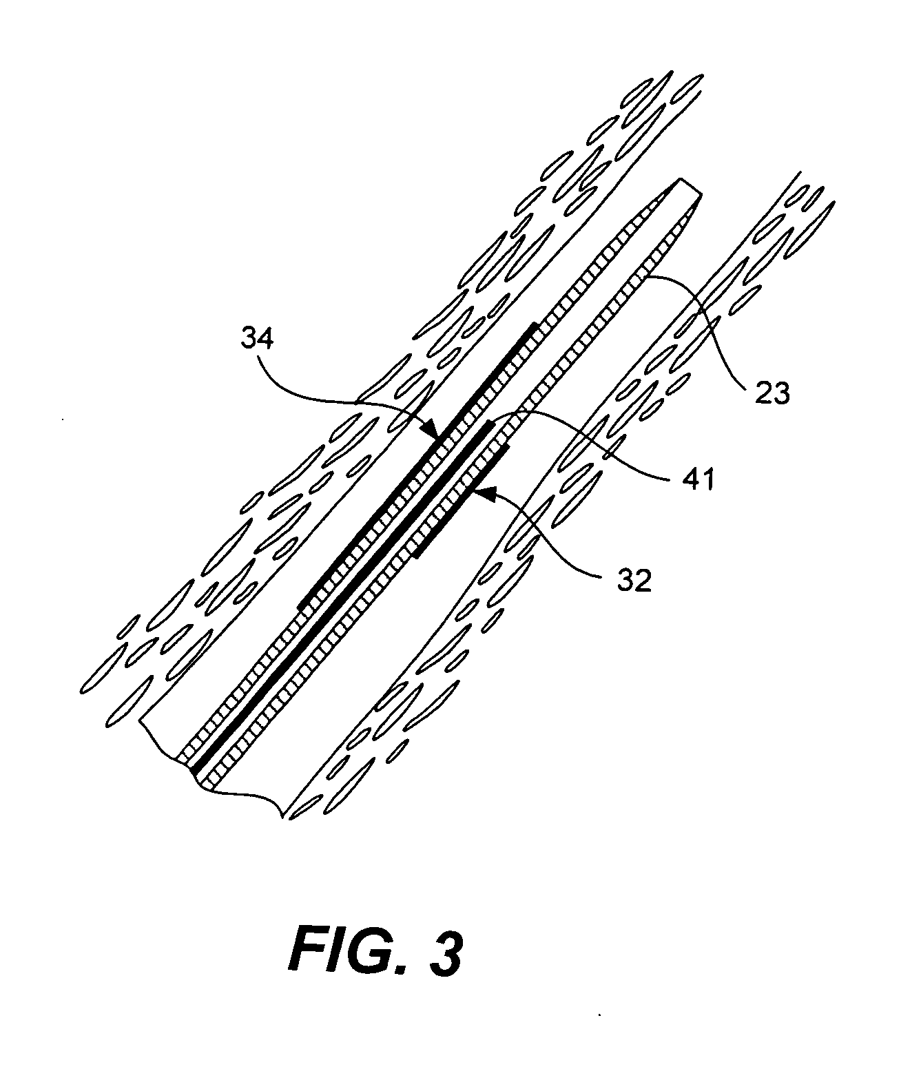 Catheter having markers to indicate rotational orientation