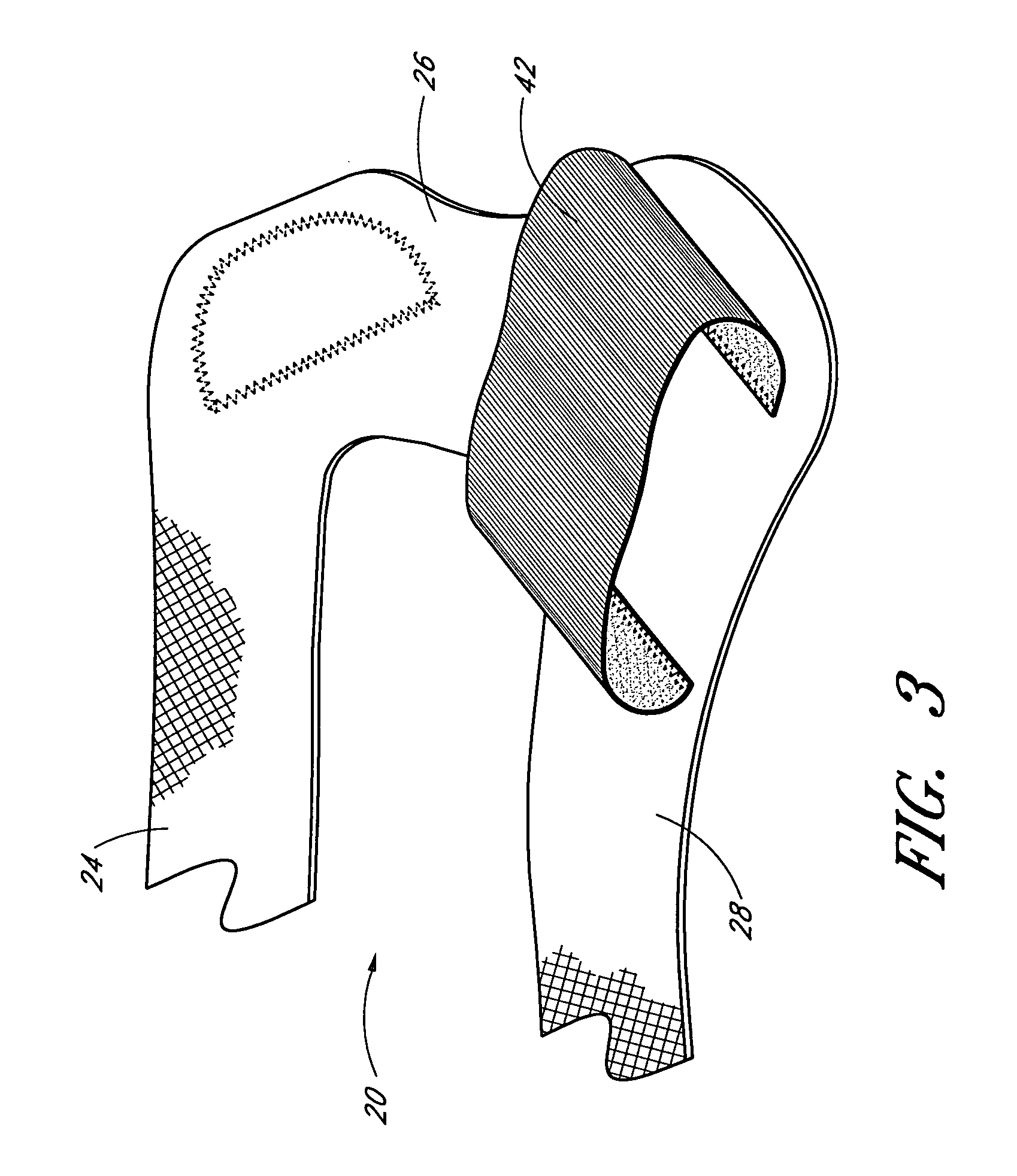 Device and method for externally rotating the femur