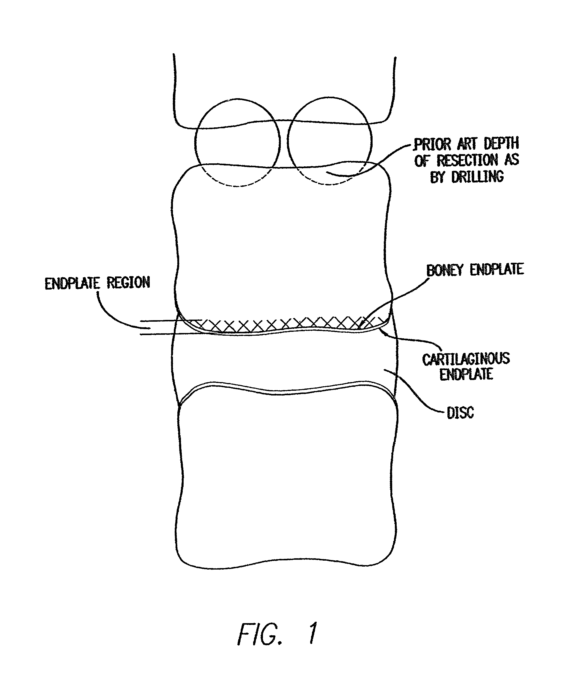 Dynamic lordotic guard with movable extensions for creating an implantation space posteriorly in the lumbar spine and method for use thereof