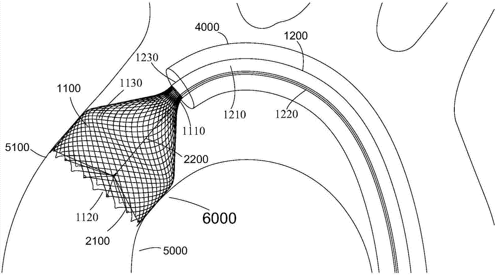 thrombus filter