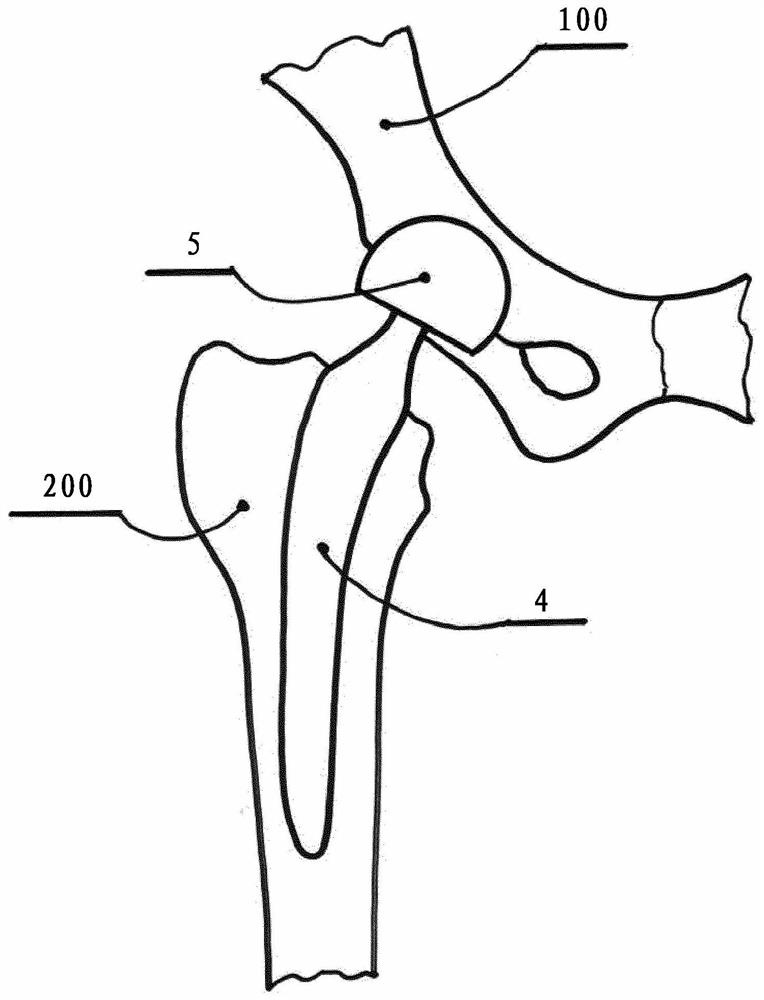 Resurfacing cup for acetabulum hemiarthroplasty of hip joint