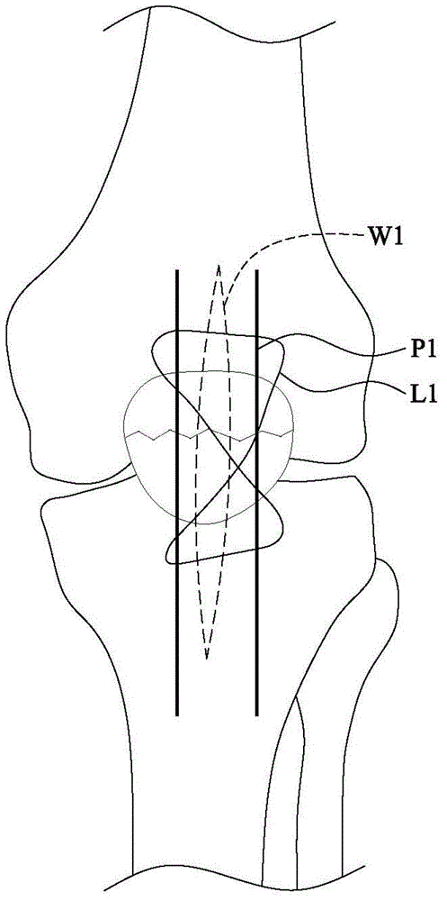 Skeleton fixing device