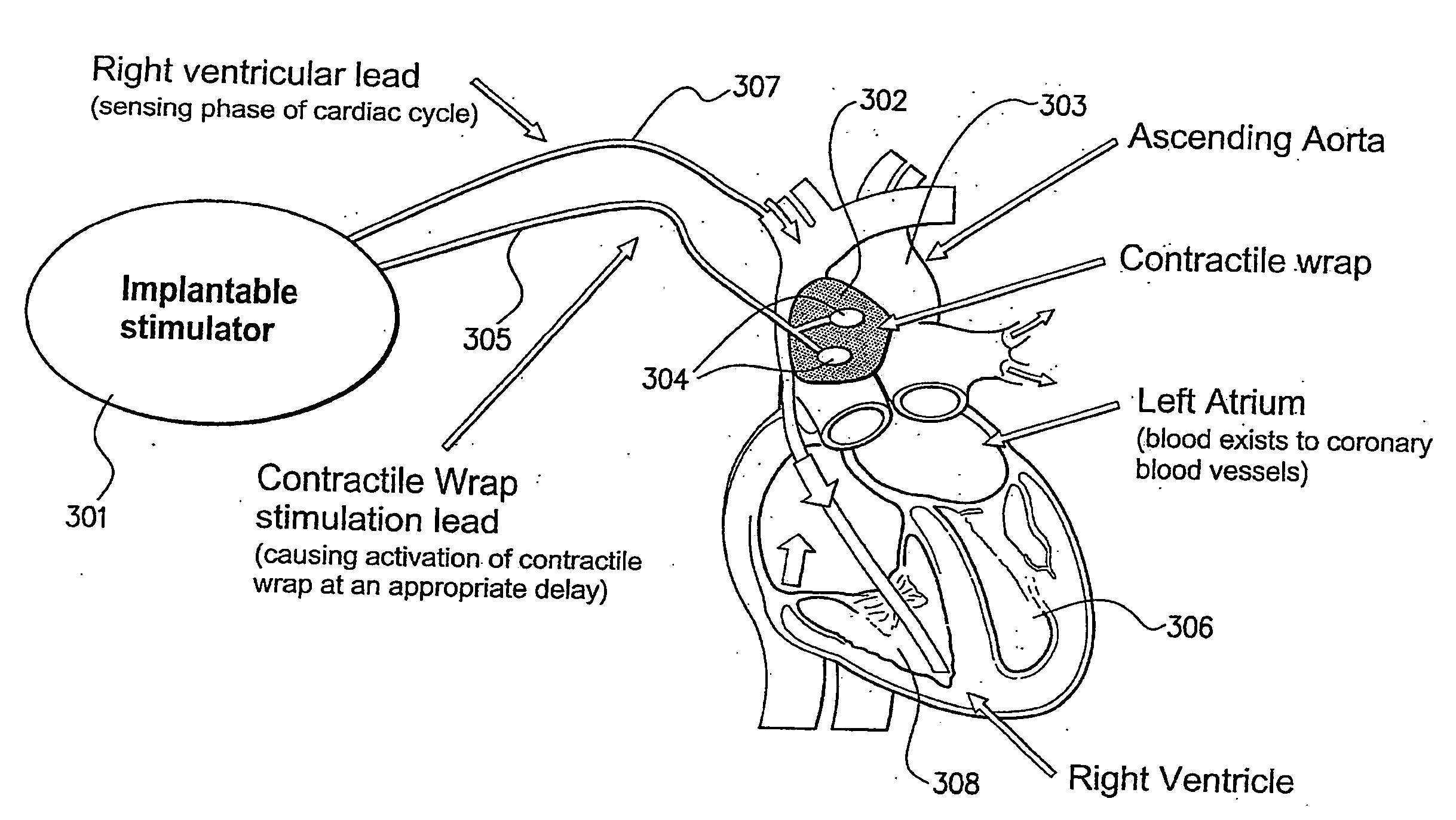 Smooth muscle implant for managing a medical condition