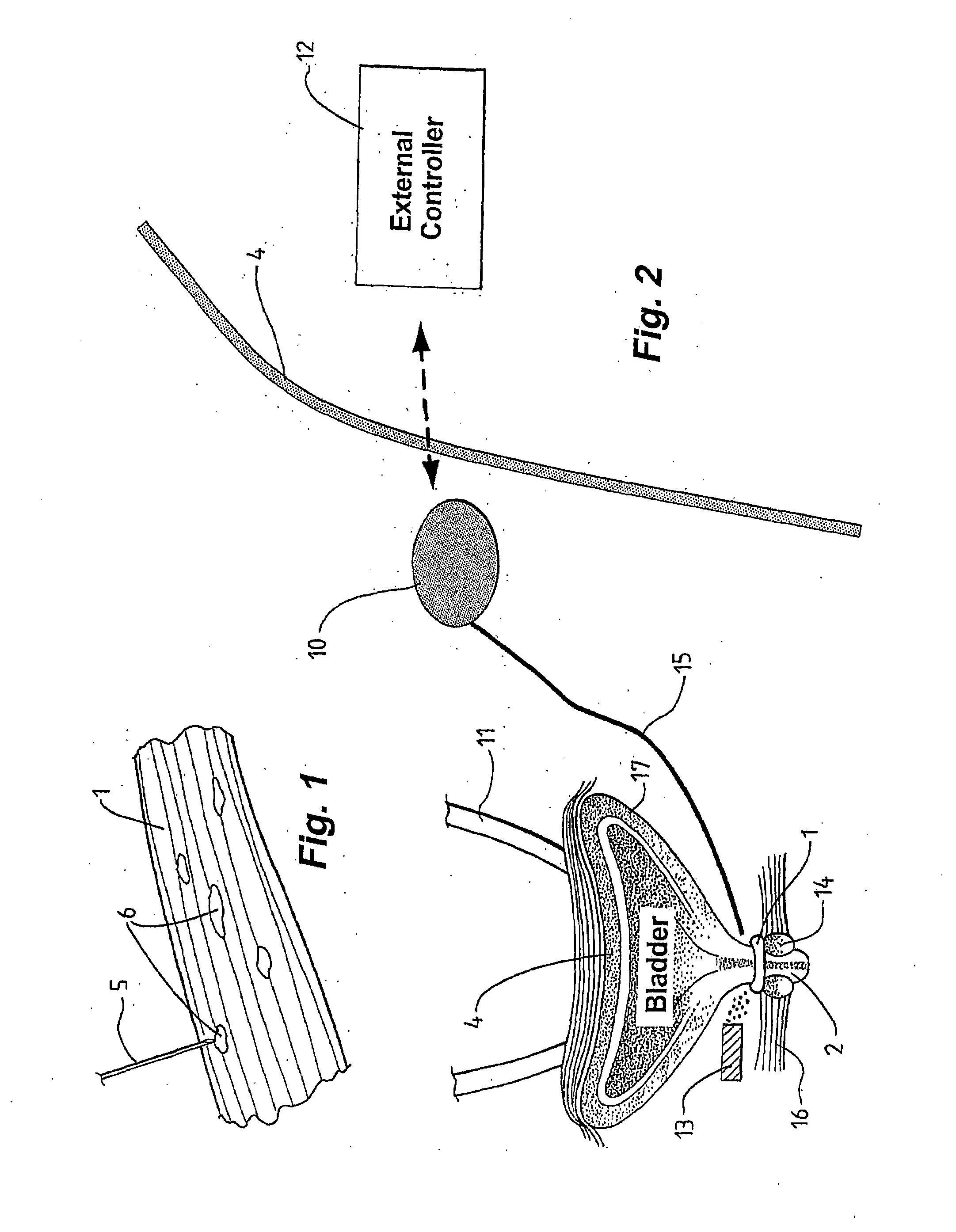Smooth muscle implant for managing a medical condition