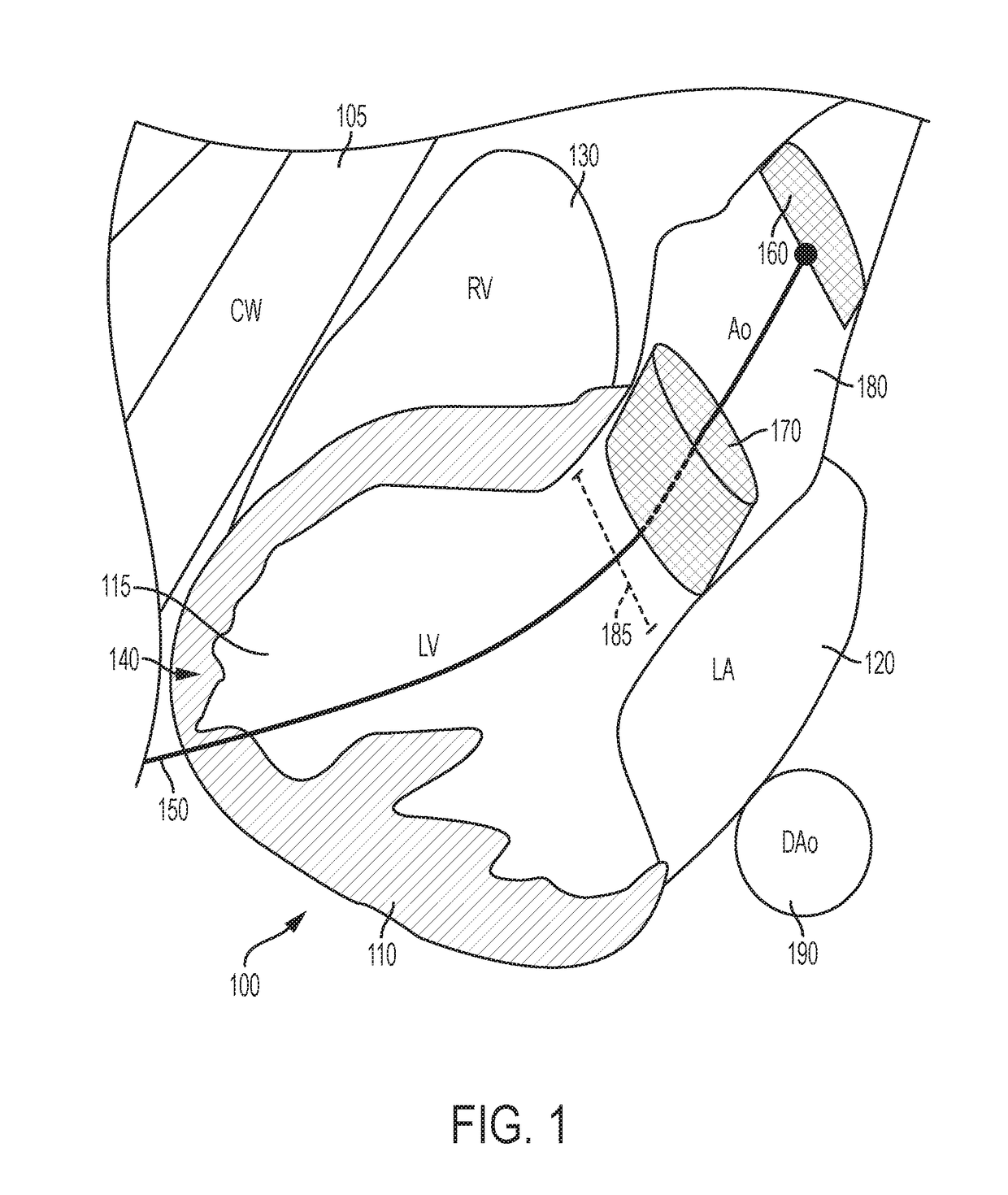 Devices and methods for image-guided percutaneous cardiac valve implantation and repair