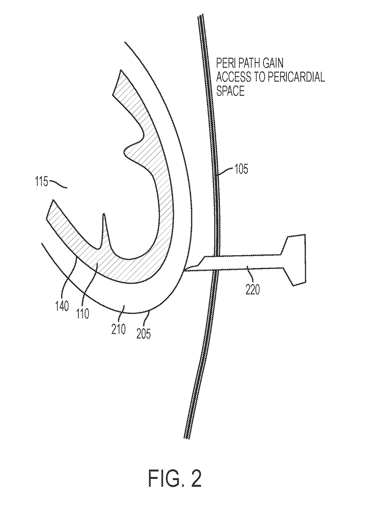 Devices and methods for image-guided percutaneous cardiac valve implantation and repair