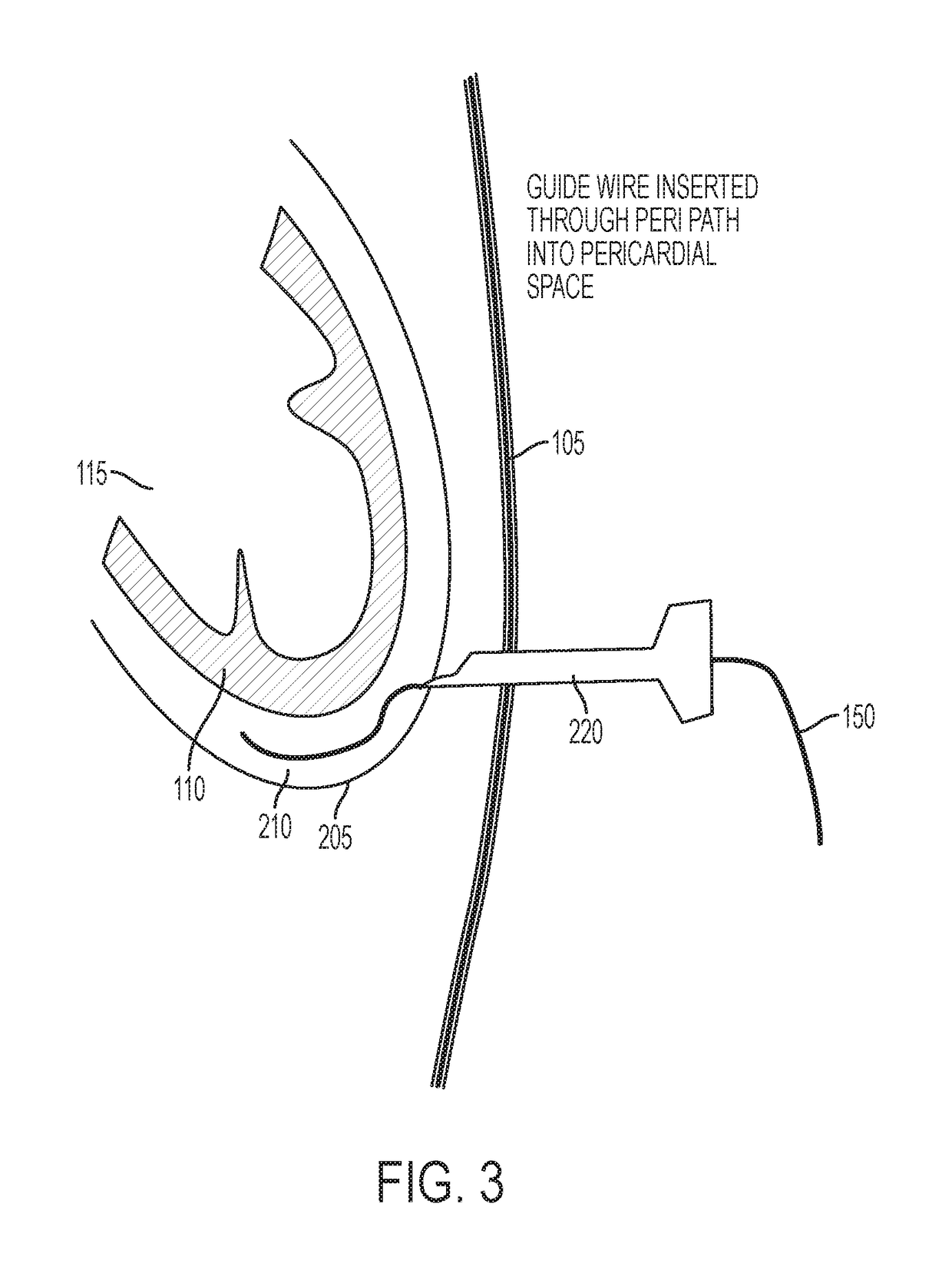 Devices and methods for image-guided percutaneous cardiac valve implantation and repair