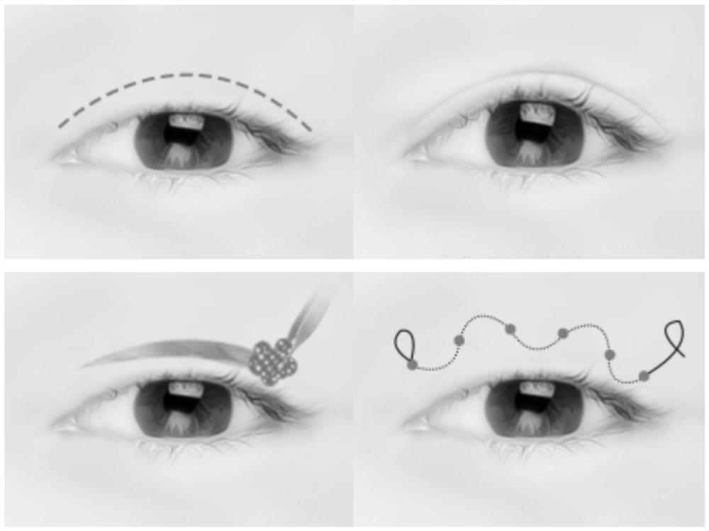 Automatic line drawing system and method before double-eyelid operation based on visual identification