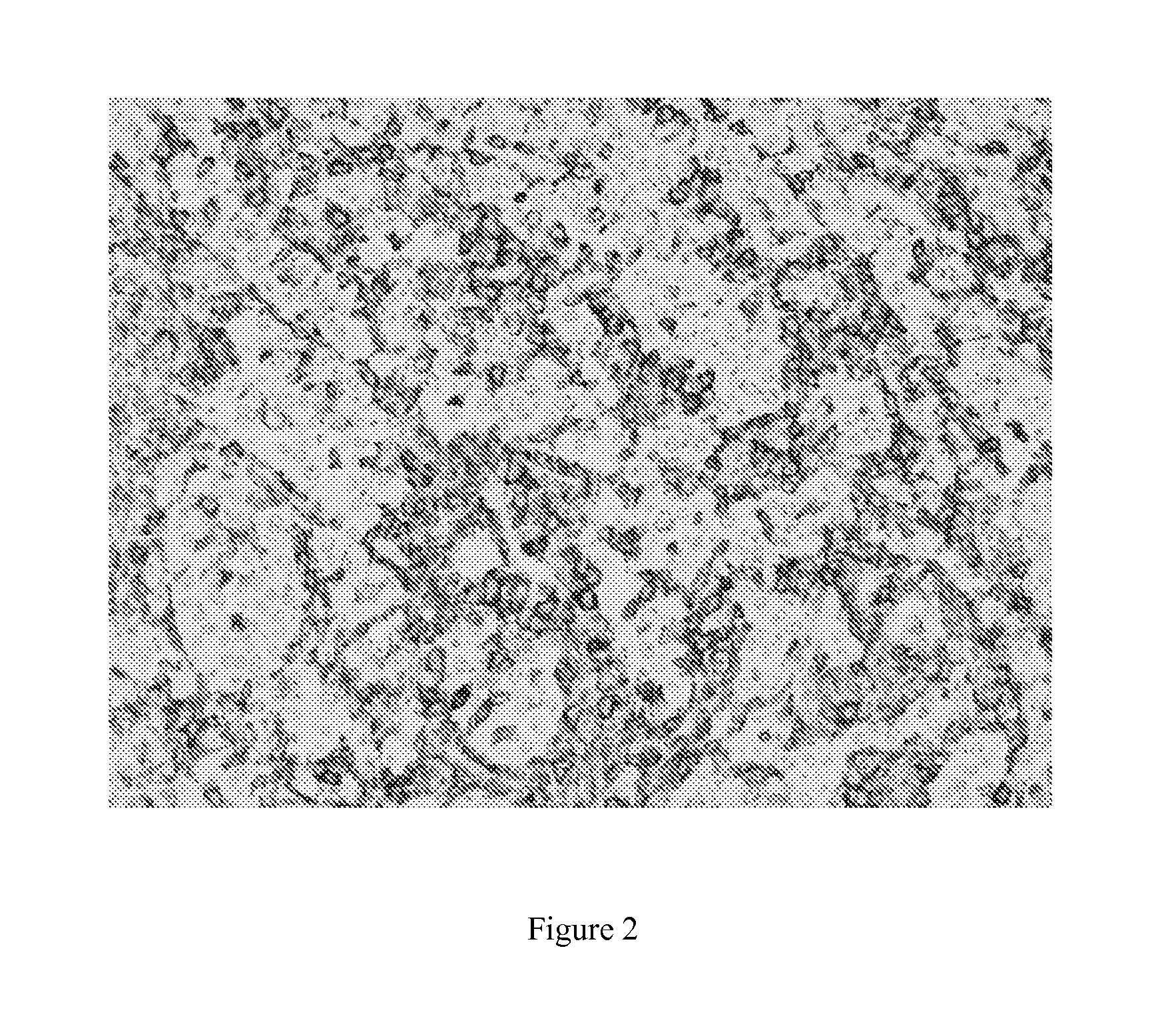 Methods and materials for treating renal cell carcinoma