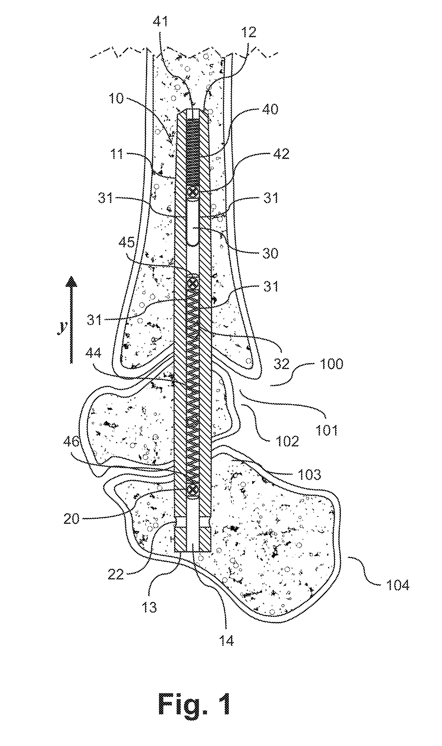 Intramedullary nail, system, and method with dynamic compression