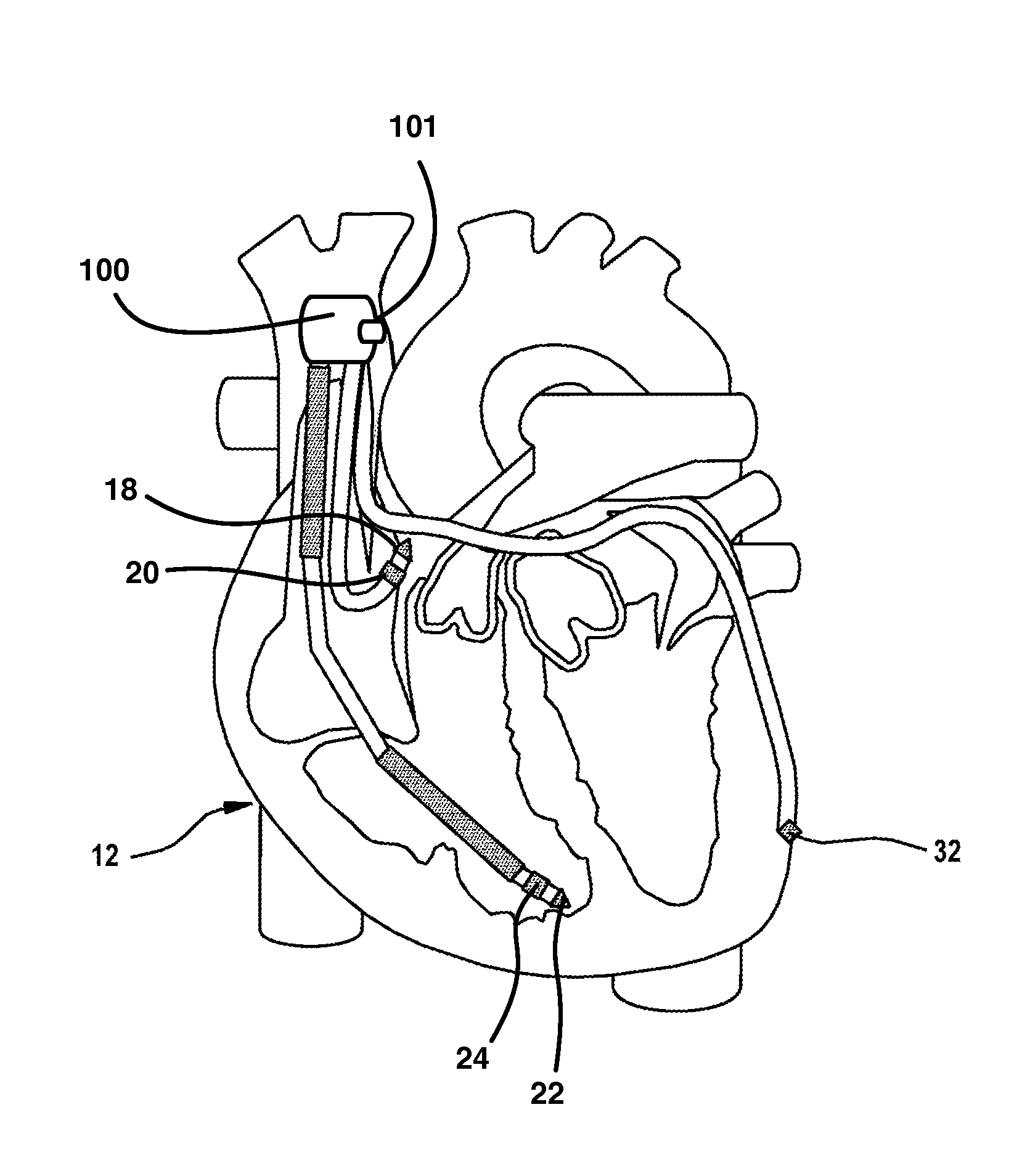System for temporary fixation of an implantable medical device