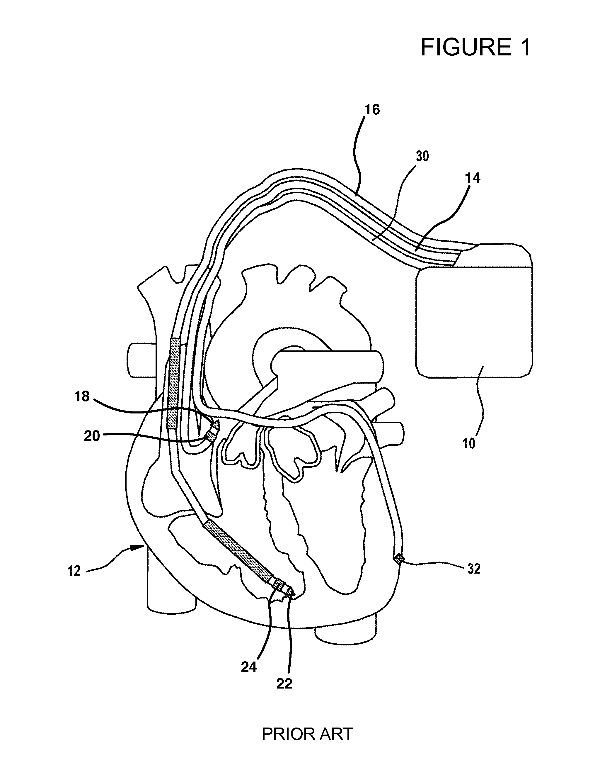 System for temporary fixation of an implantable medical device