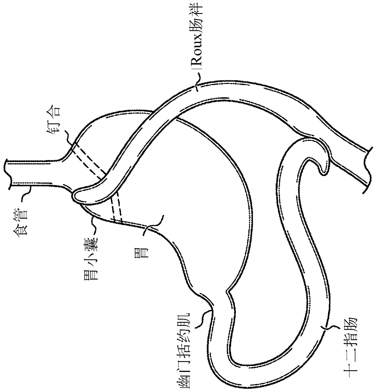 Device for bariatric stent allowing normal function of pyloric sphincter
