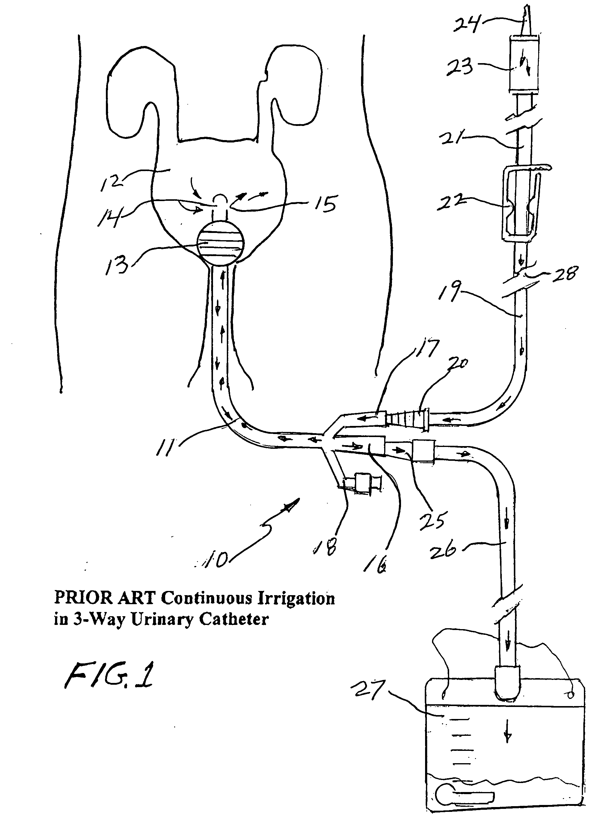 Closed system irrigation connector for urinary catheters