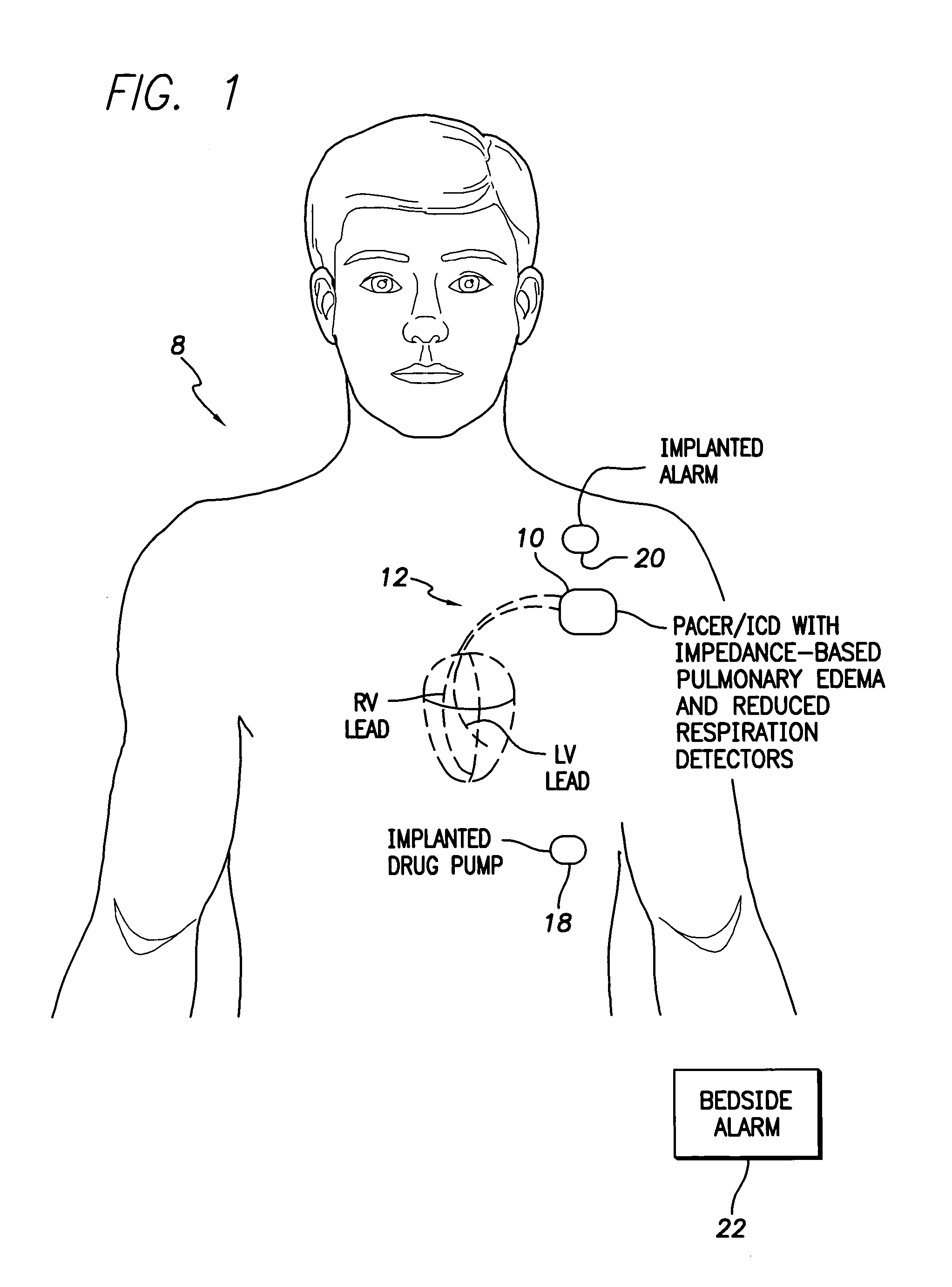 System and method for impedance-based detection of pulmonary edema and reduced respiration using an implantable medical system