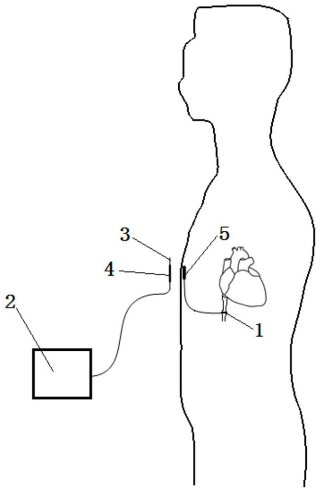 A multi-receiving terminal wireless power transmission auxiliary blood supply device with a relay coil